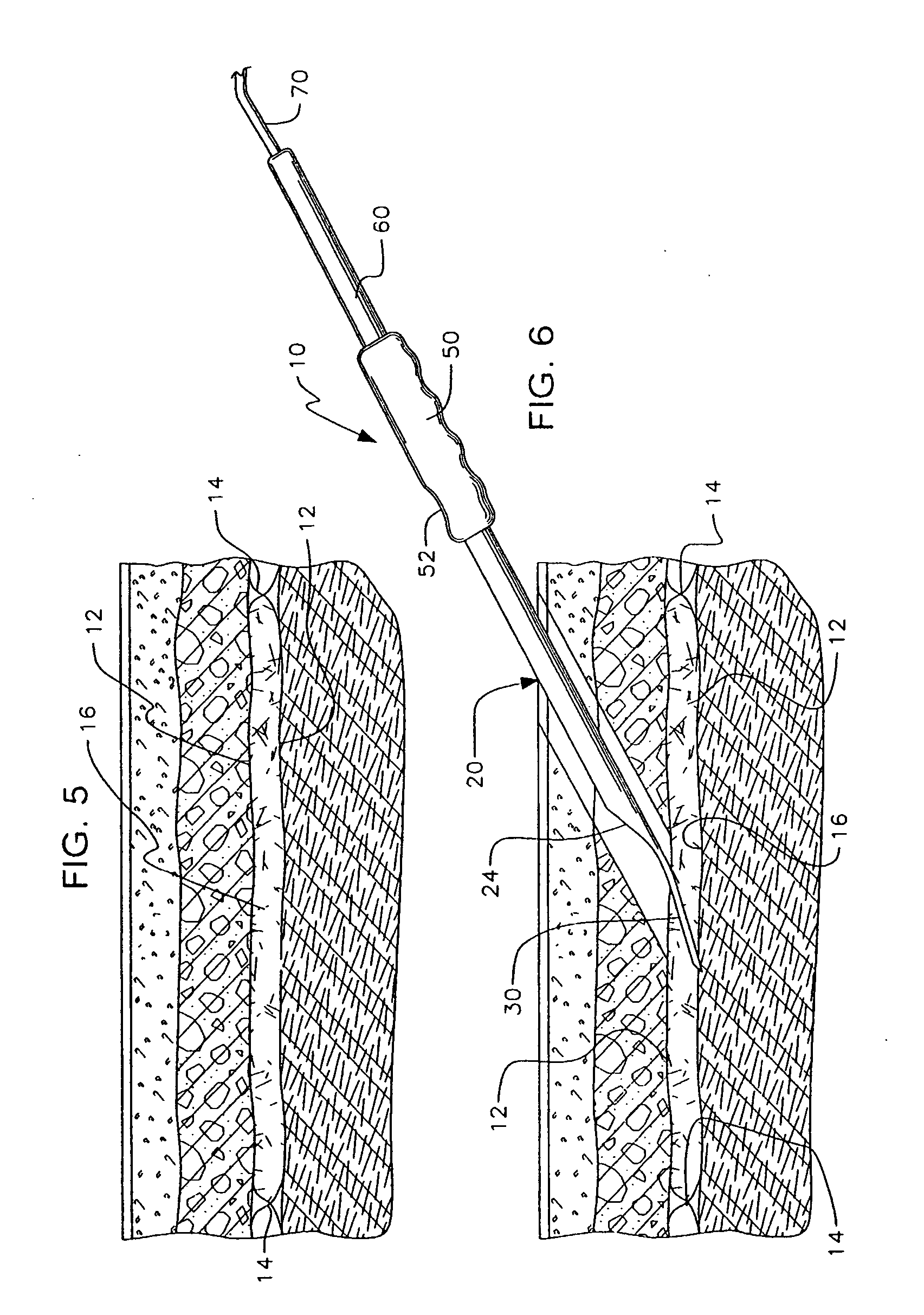 Apparatus for use in fascial cleft surgery for opening an anatomic space