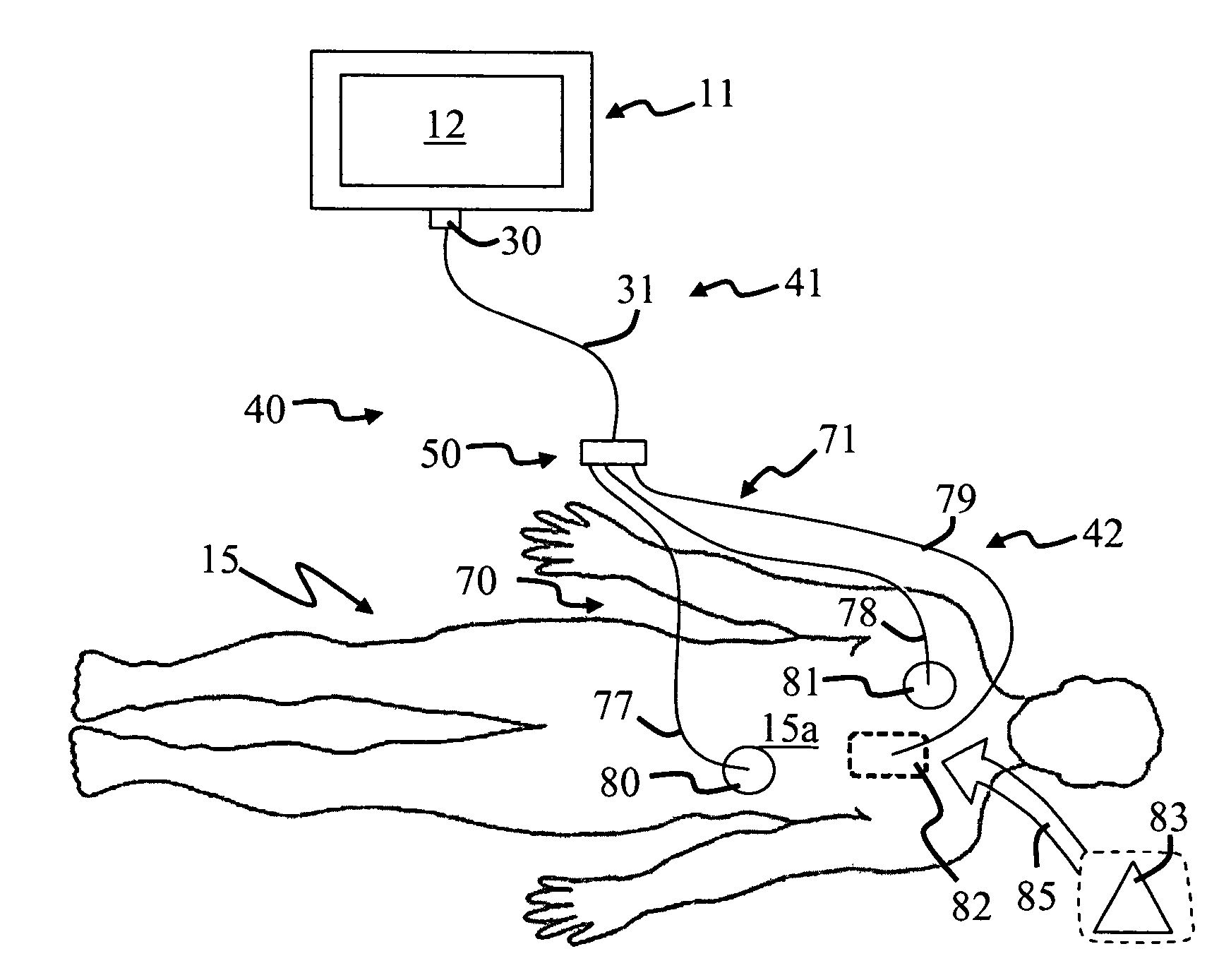 Electrode system for a physiological stimulator