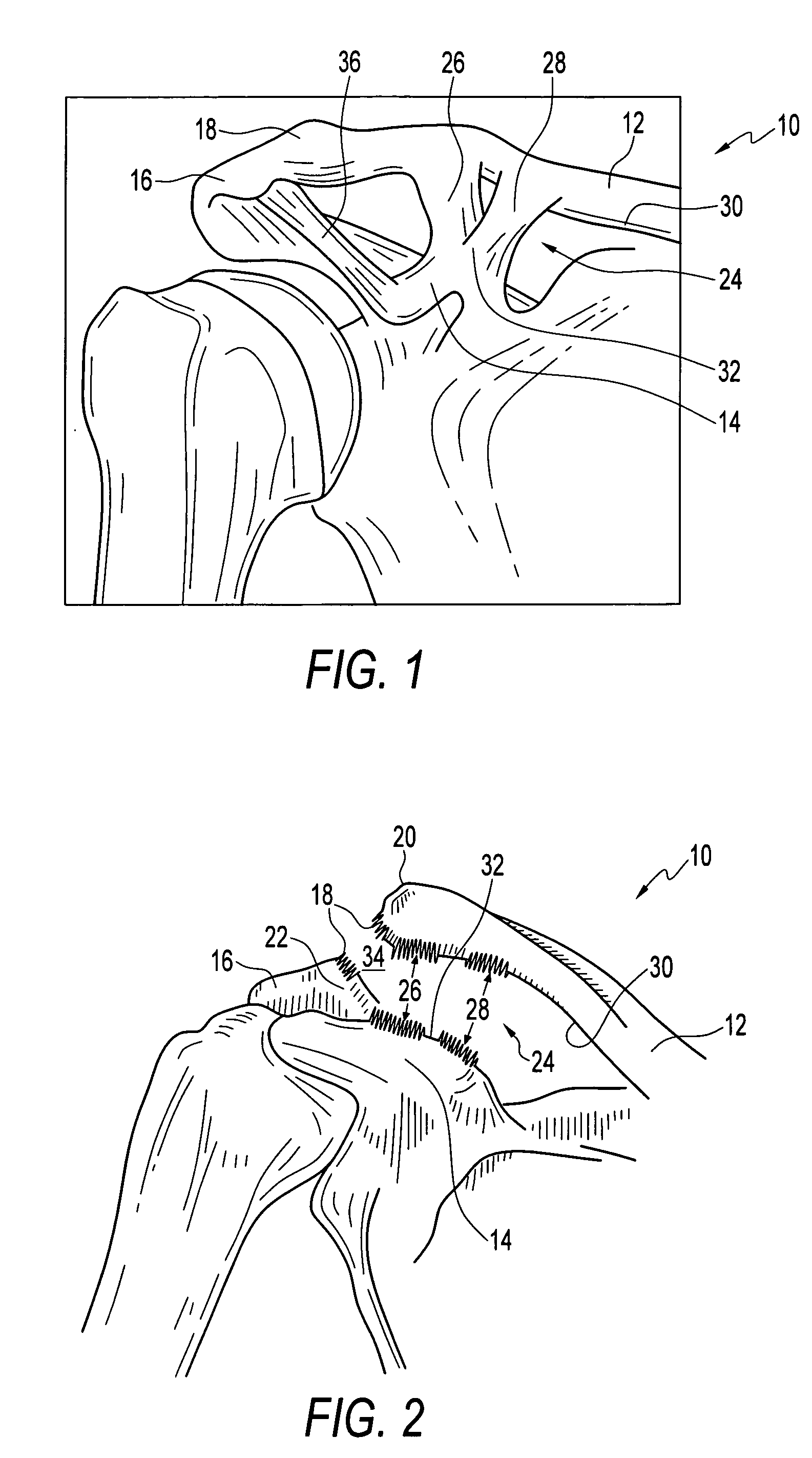Method and apparatus for internal fixation of an acromioclavicular joint dislocation of the shoulder