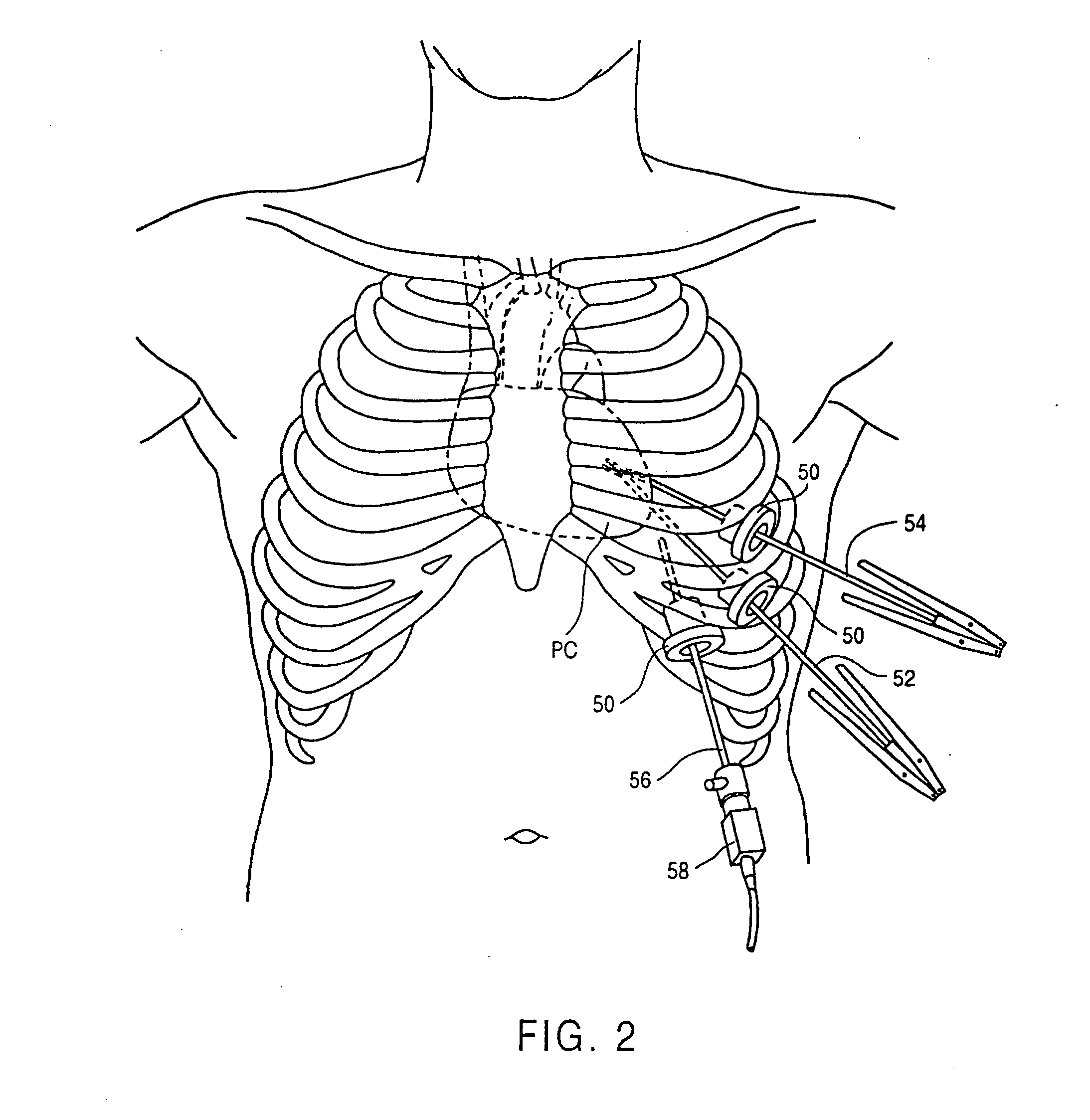 Minimally-invasive devices and methods for treatment of congestive heart failure