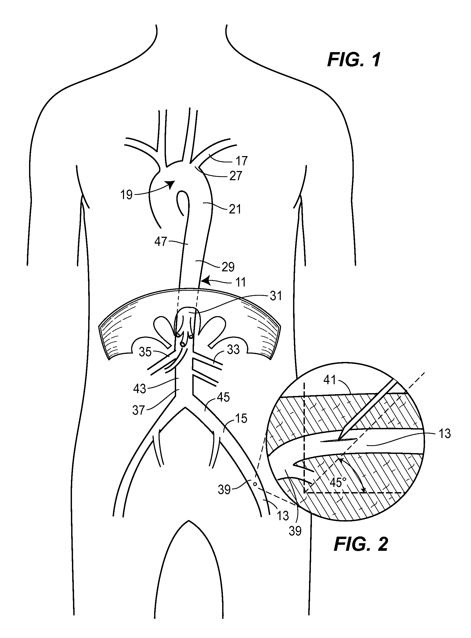 Fluoroscopy-independent, endovascular aortic occlusion system