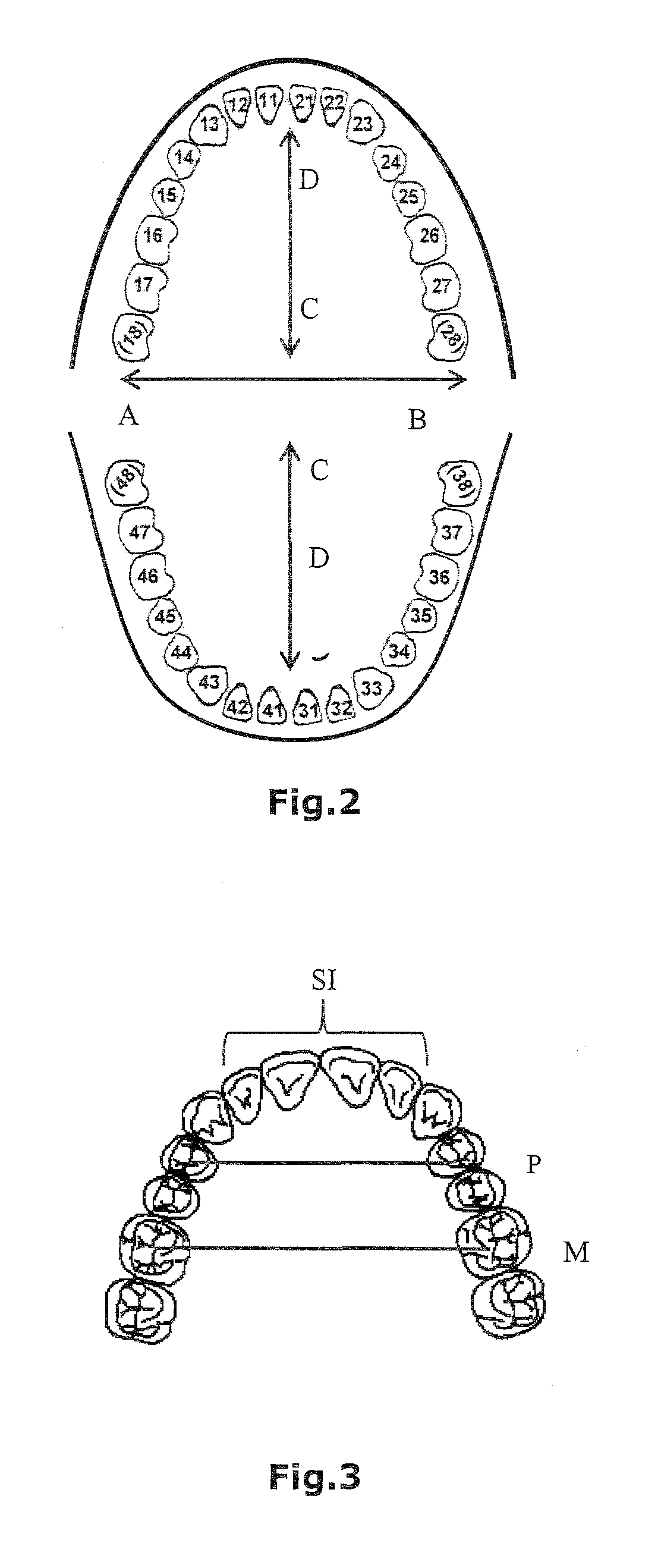 Method for preparing a partial or full dental prosthesis