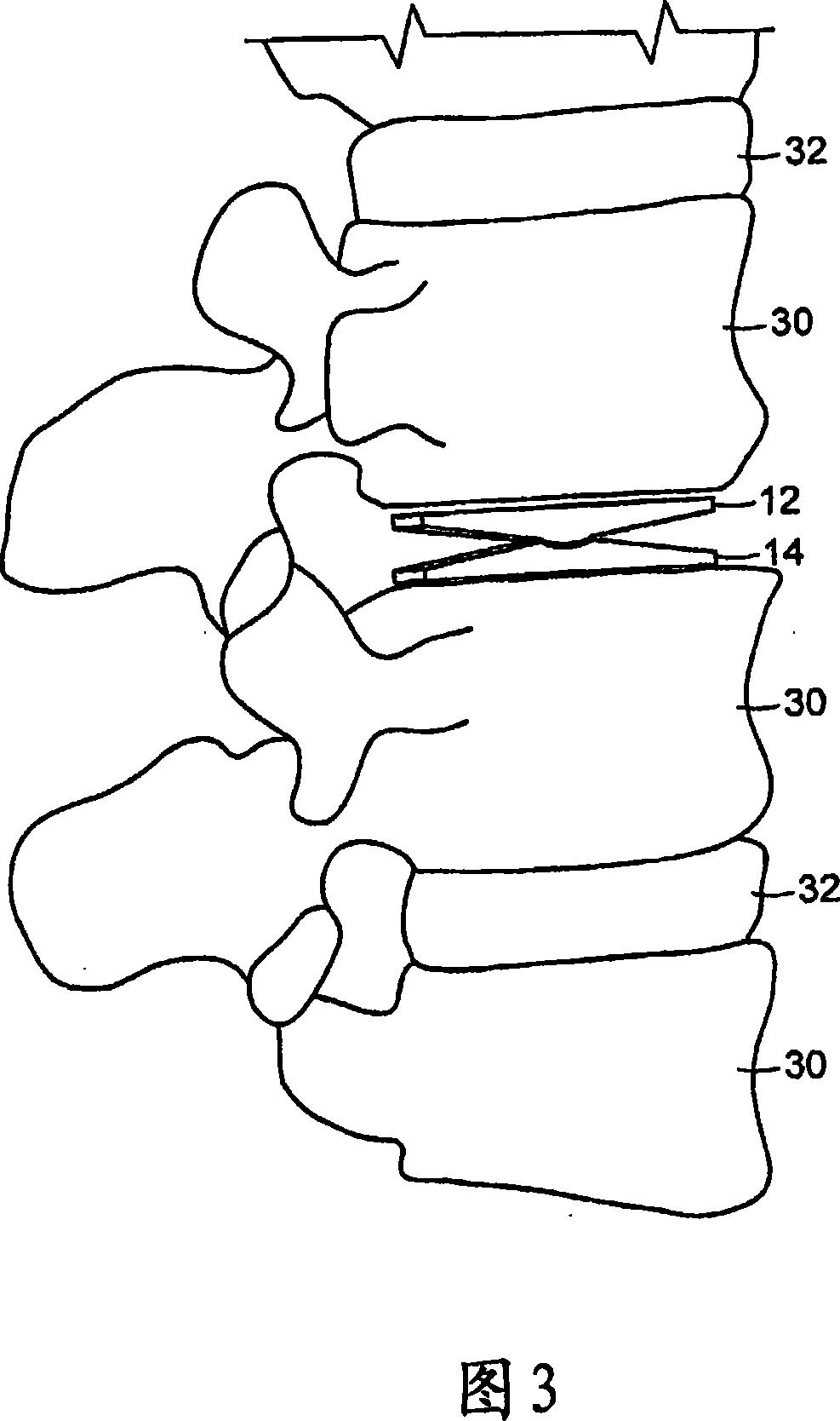 Minimally invasive spinal disc stabilizer and insertion tool