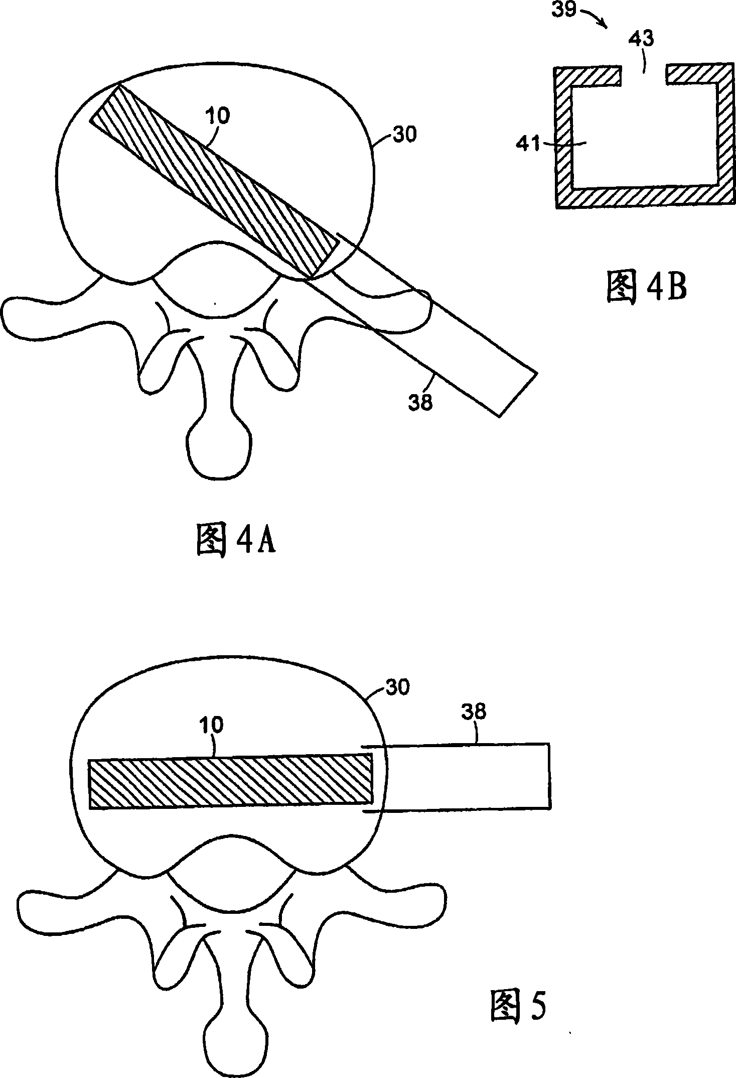 Minimally invasive spinal disc stabilizer and insertion tool