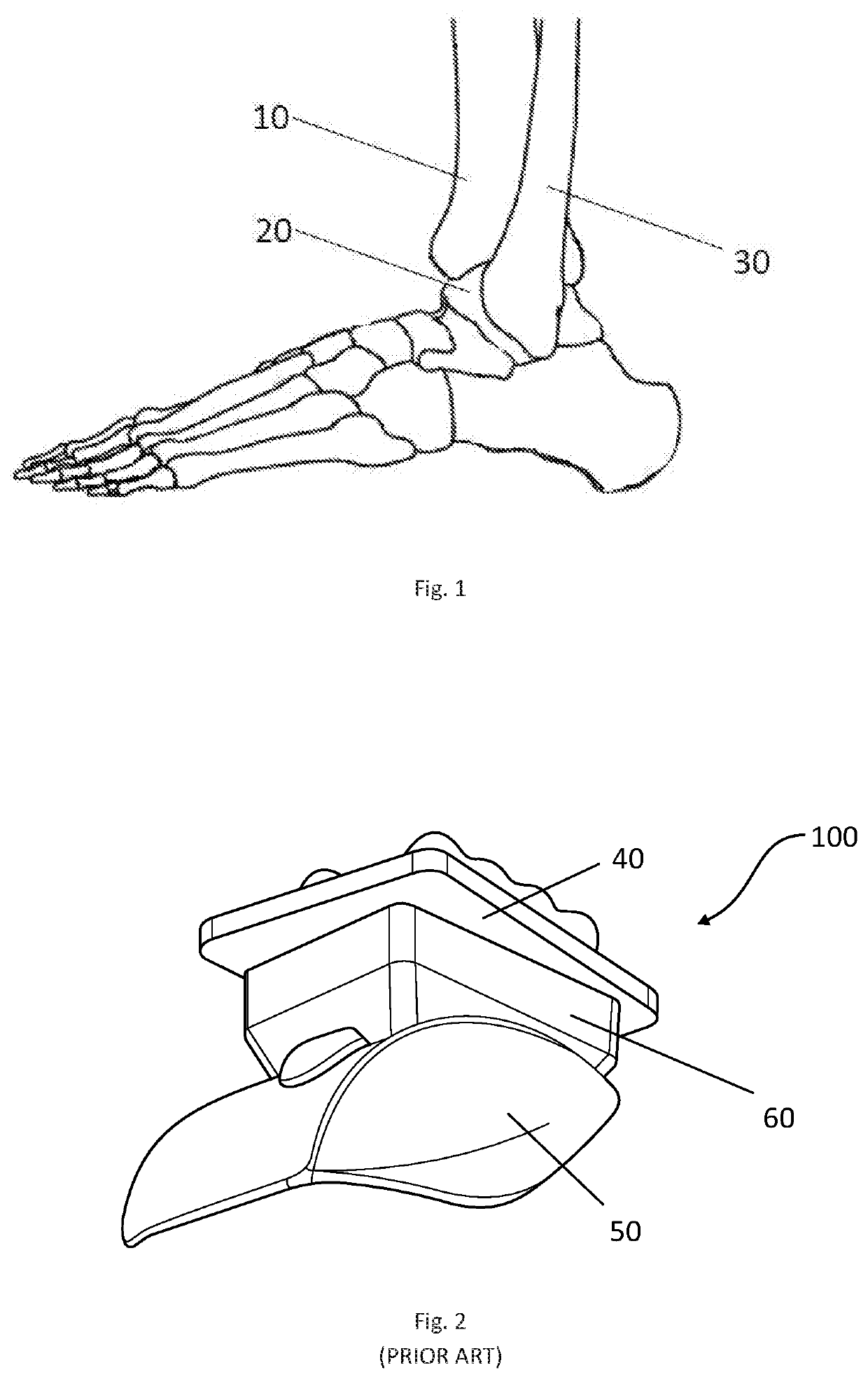 Talar Ankle Implant