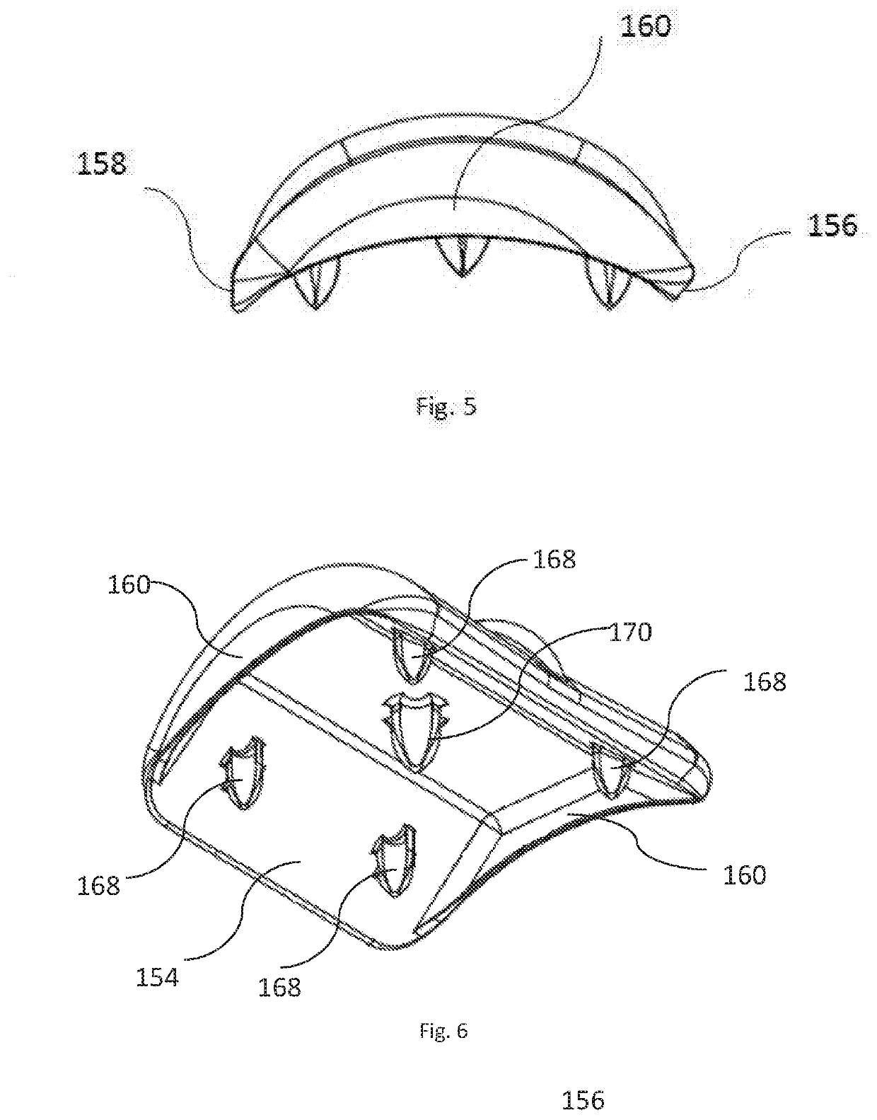 Talar Ankle Implant