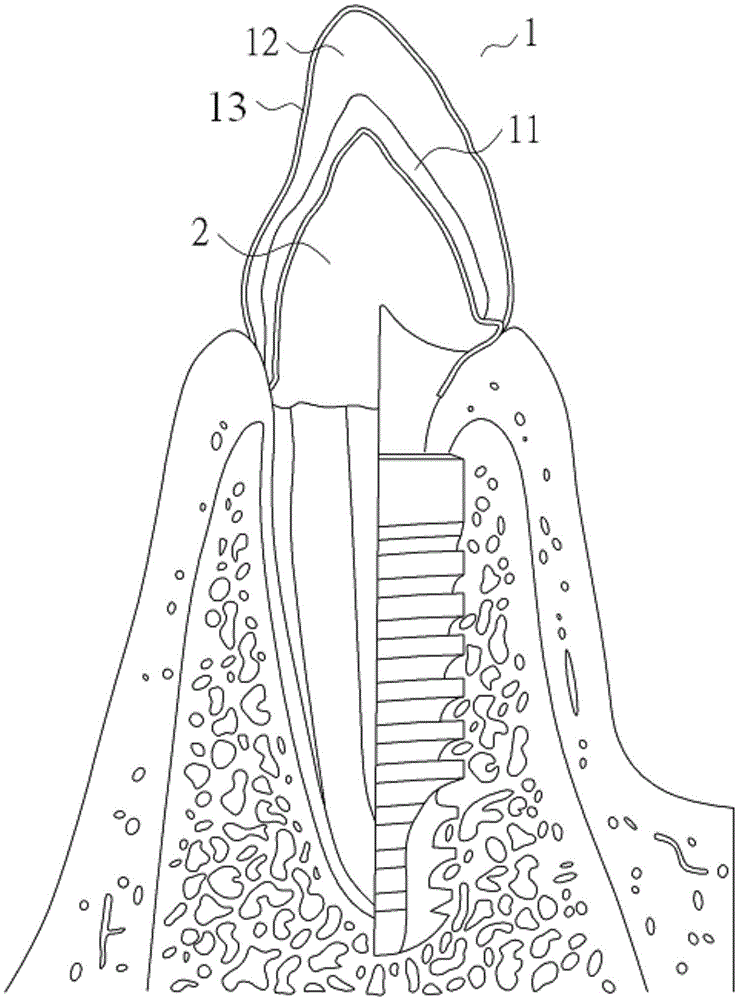 Dental crown and manufacturing method thereof