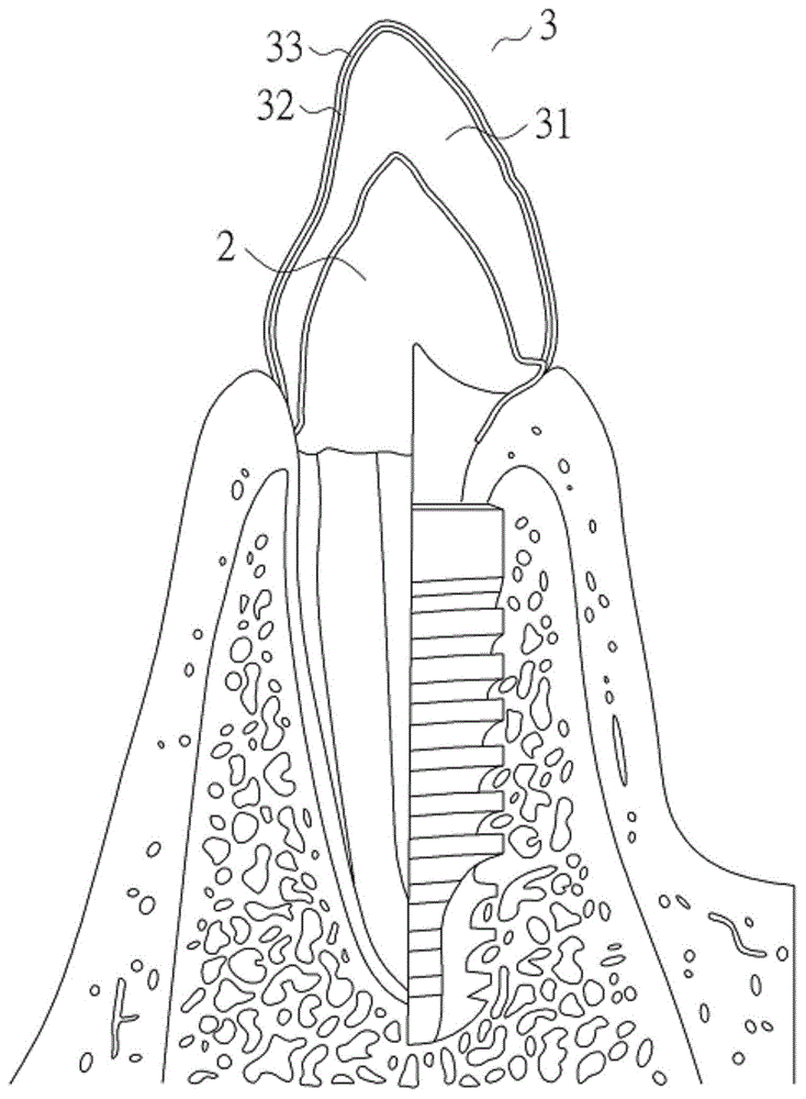 Dental crown and manufacturing method thereof