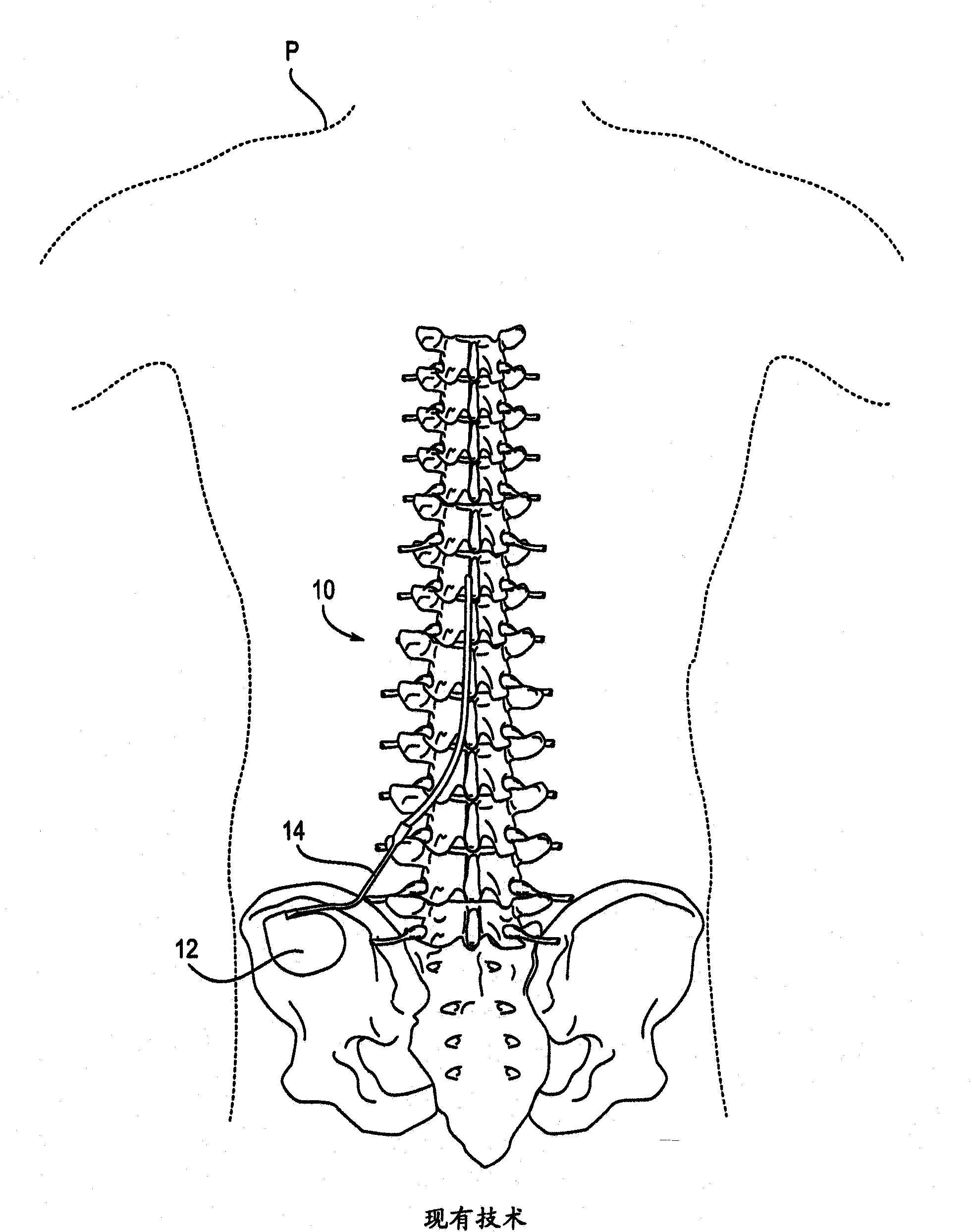 Stimulation leads, delivery systems and methods of use
