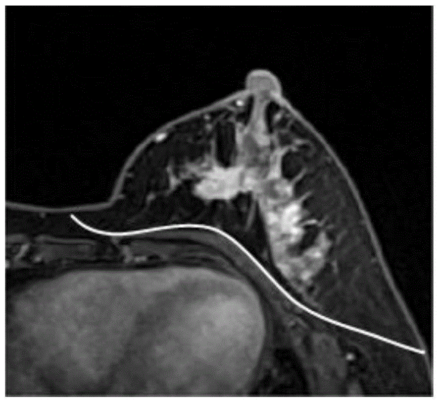 Breast tumor segmentation method based on MRI images