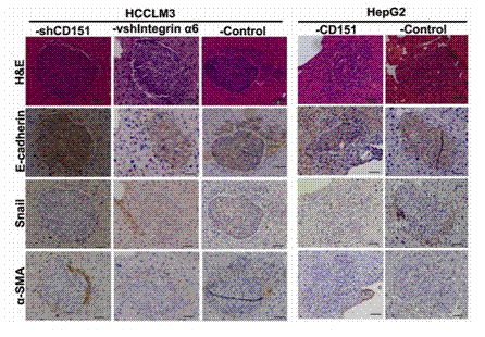 Animal model constructing method for studying epithelial and stromal hyalinosis of hepatocellular carcinoma