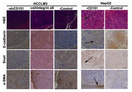 Animal model constructing method for studying epithelial and stromal hyalinosis of hepatocellular carcinoma