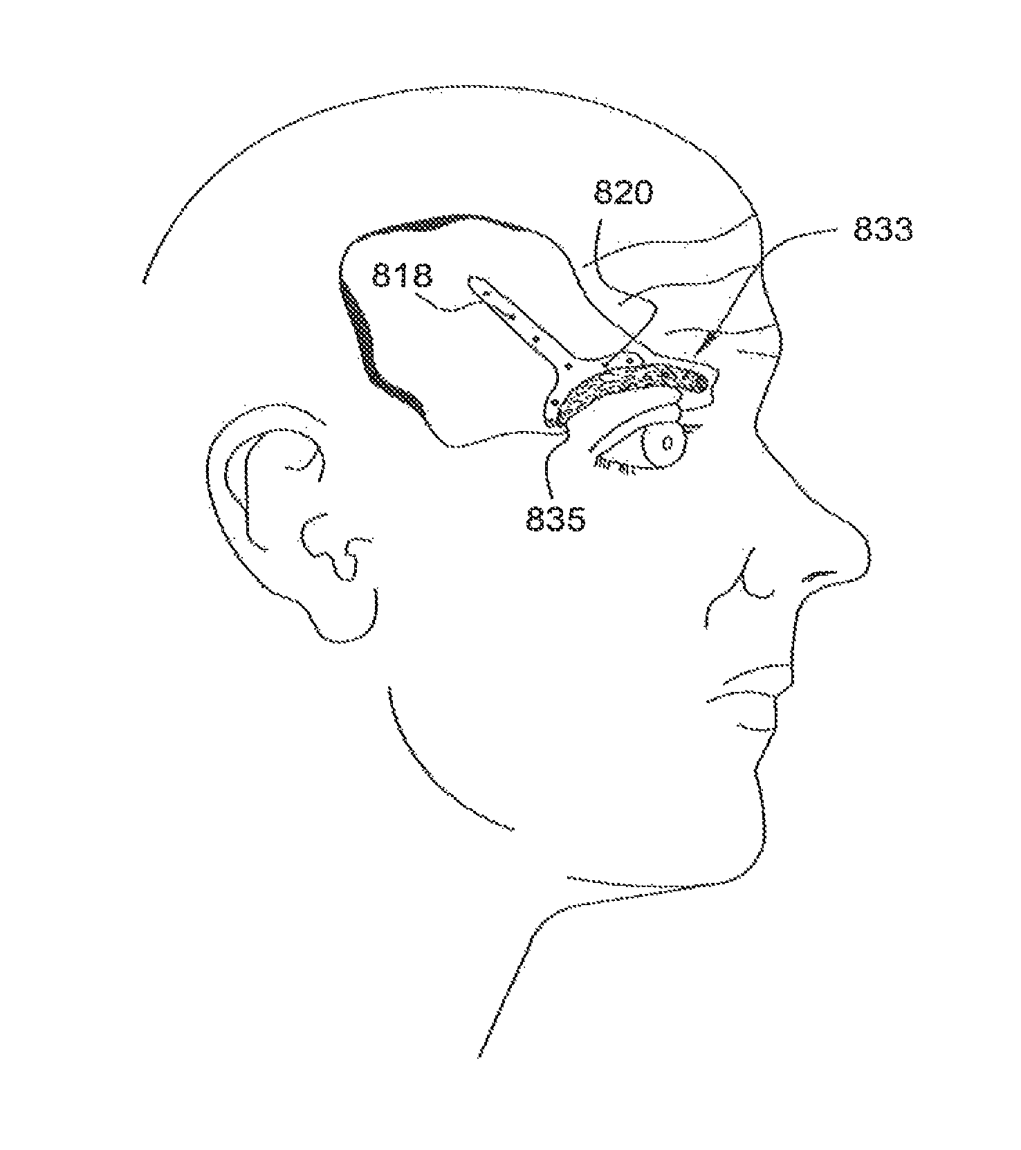 Temporal brow lifting and fixation device