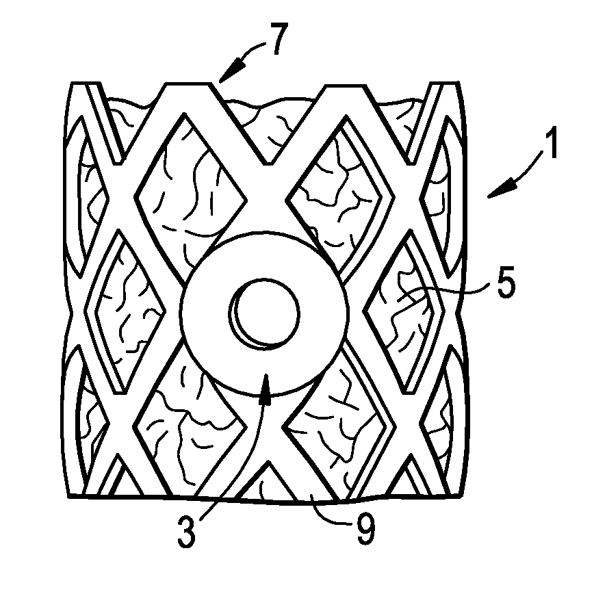 Aspirating Implants and Method of Bony Regeneration