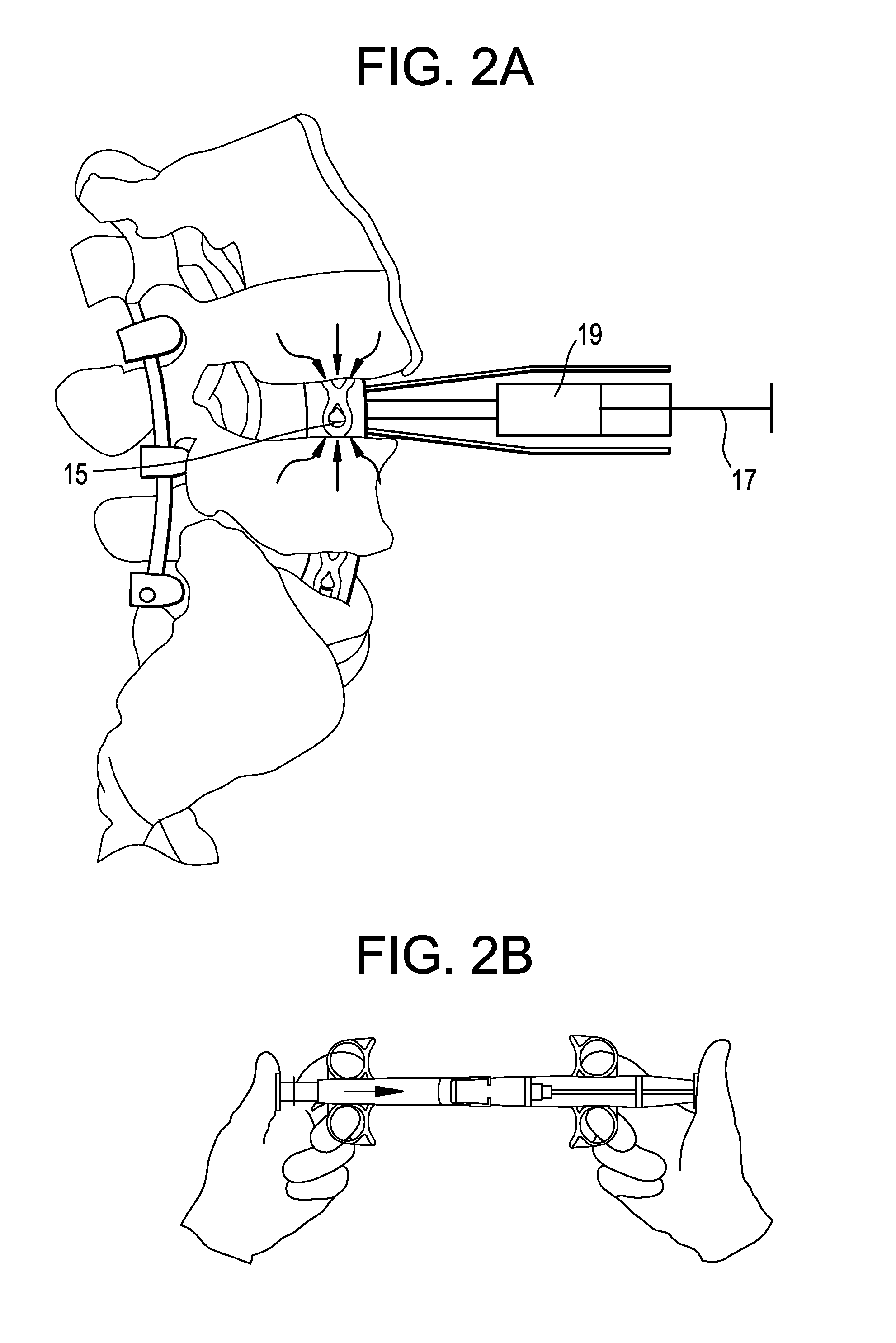 Aspirating Implants and Method of Bony Regeneration