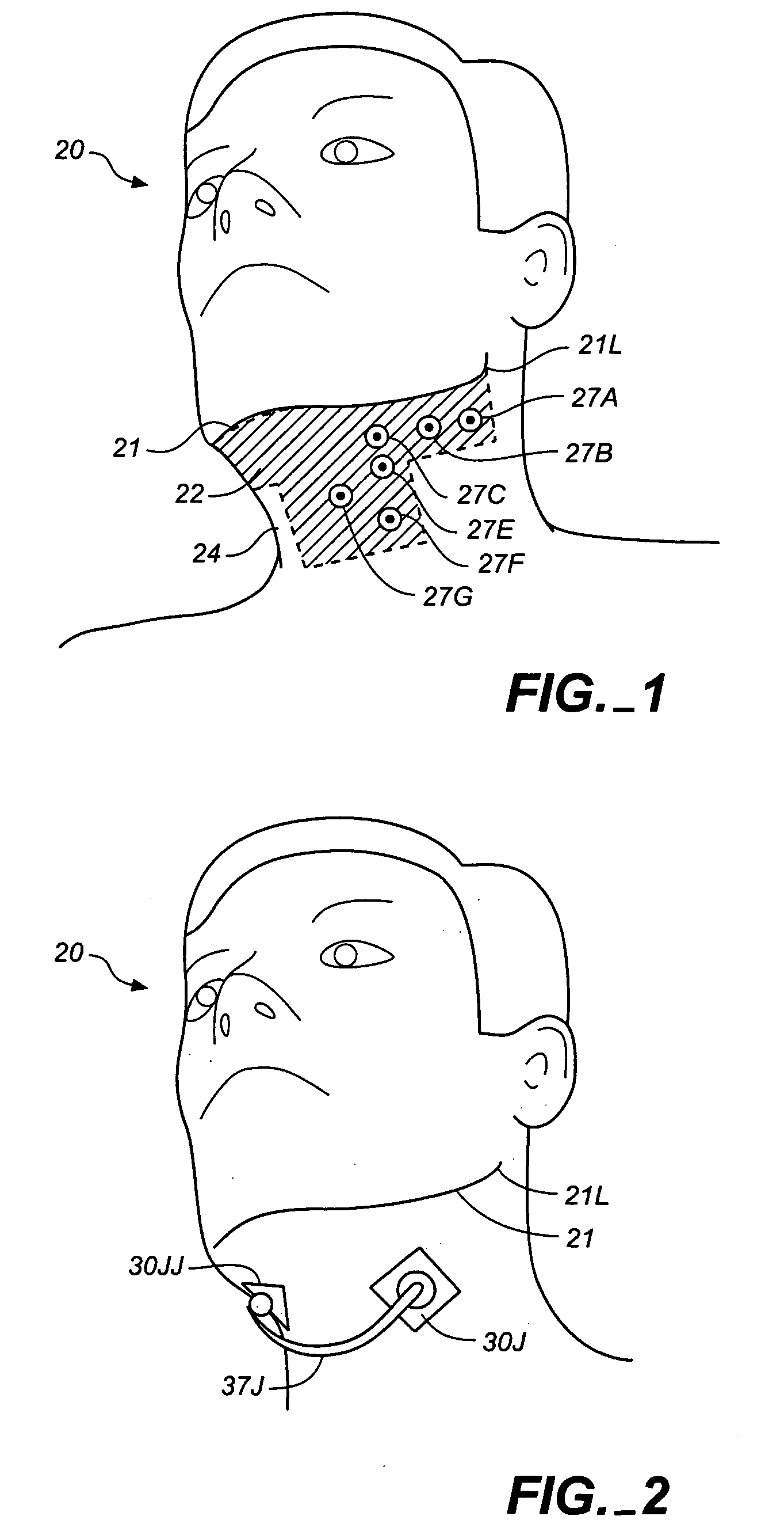 Method and apparatus for treatment of snoring and sleep apnea