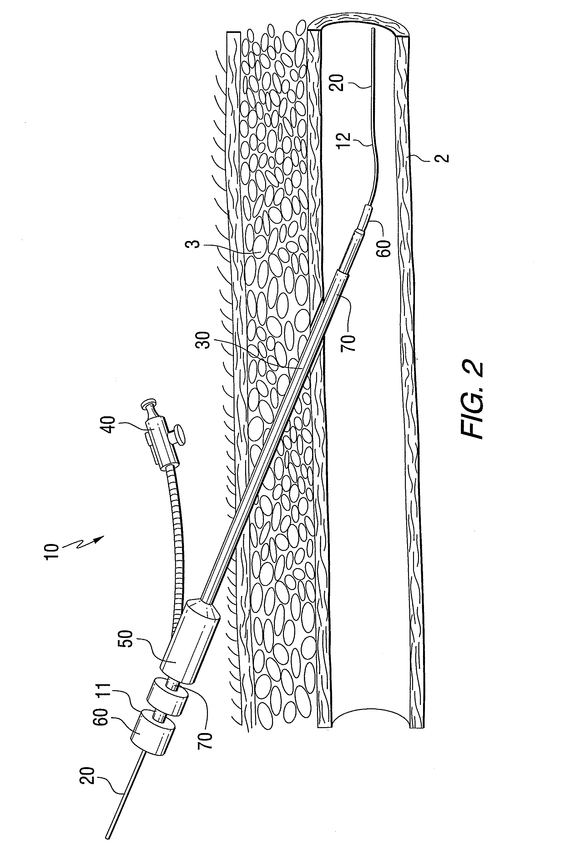 Vascular access device and method