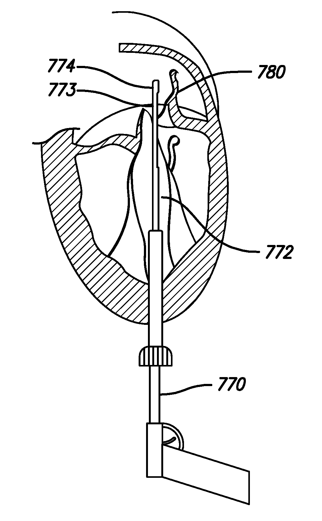 Methods and devices for performing cardiac valve repair
