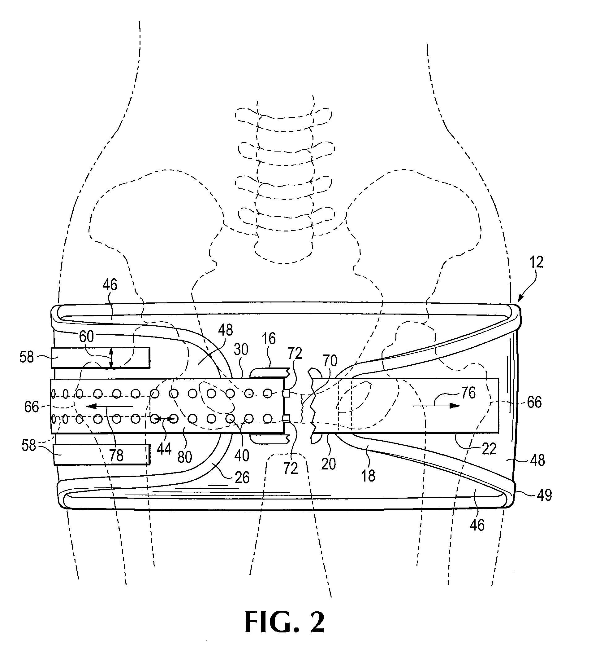 Device and method for control of hemorrhage