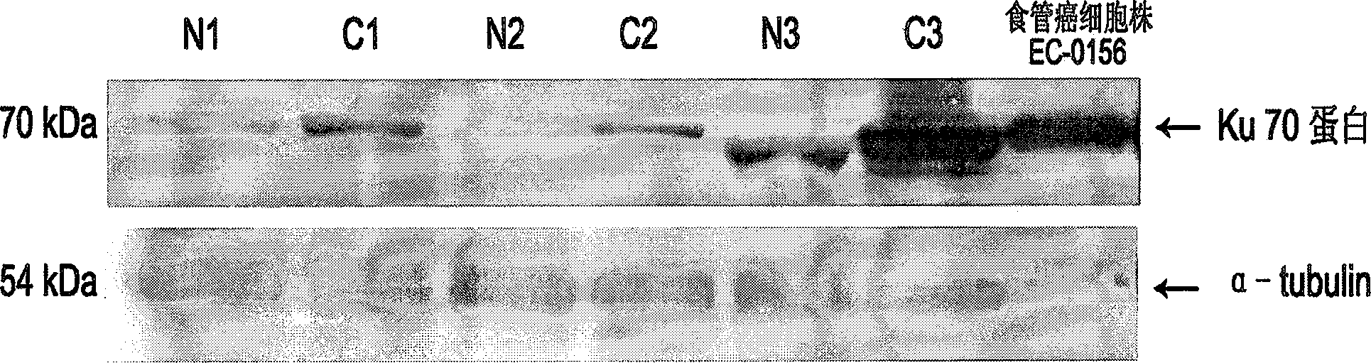 Method for detecting id marks related to tumor in blood serum from patient of oesophagus cancer