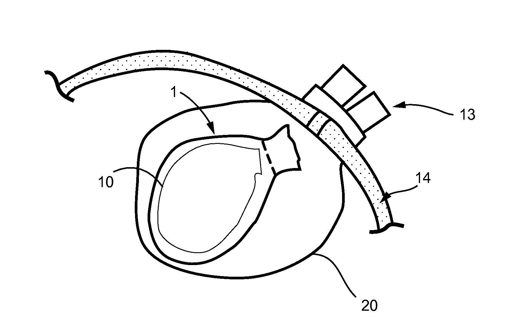 Method of amputating and morcellating a uterus