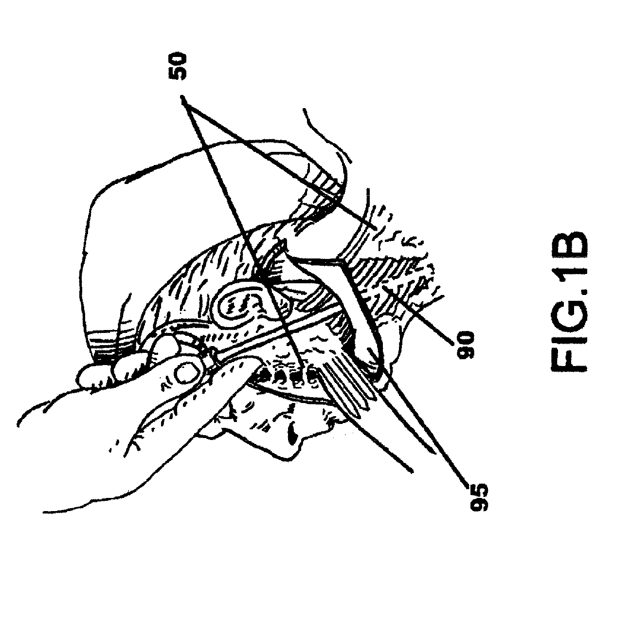 Facial tissue strengthening and tightening device and methods