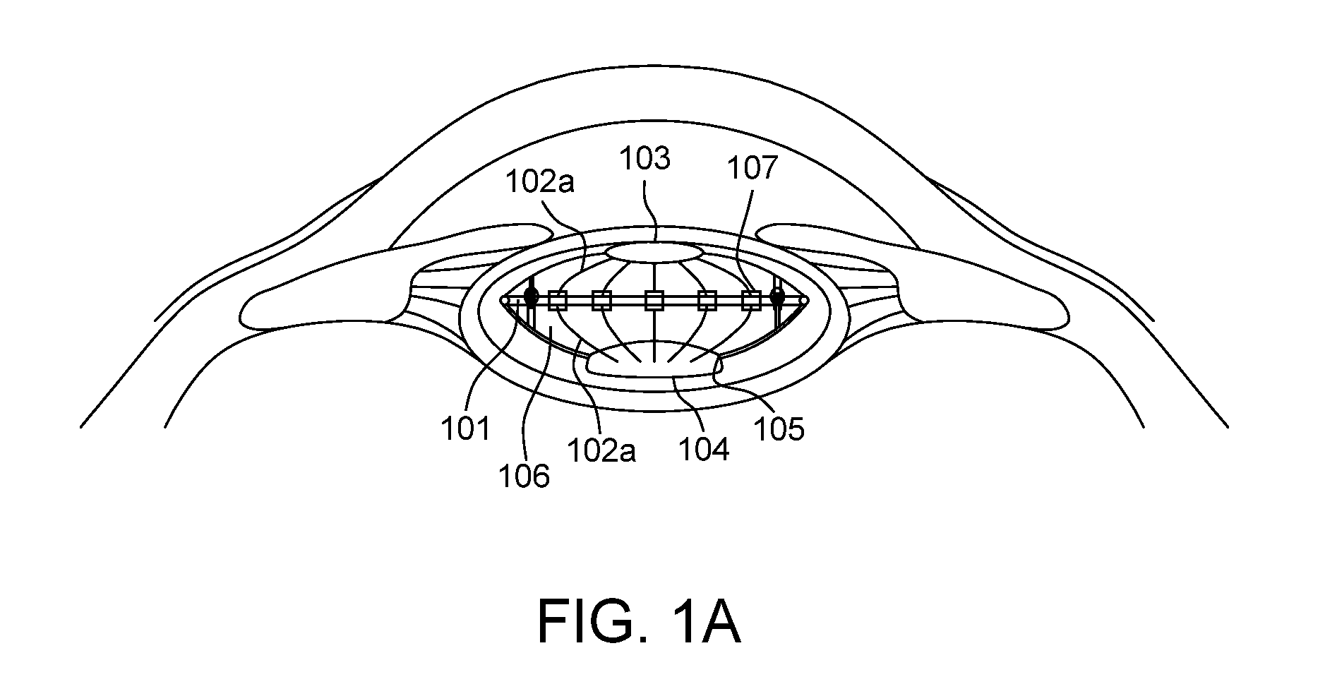 Intraocular lens (IOL) with multi optics assembly