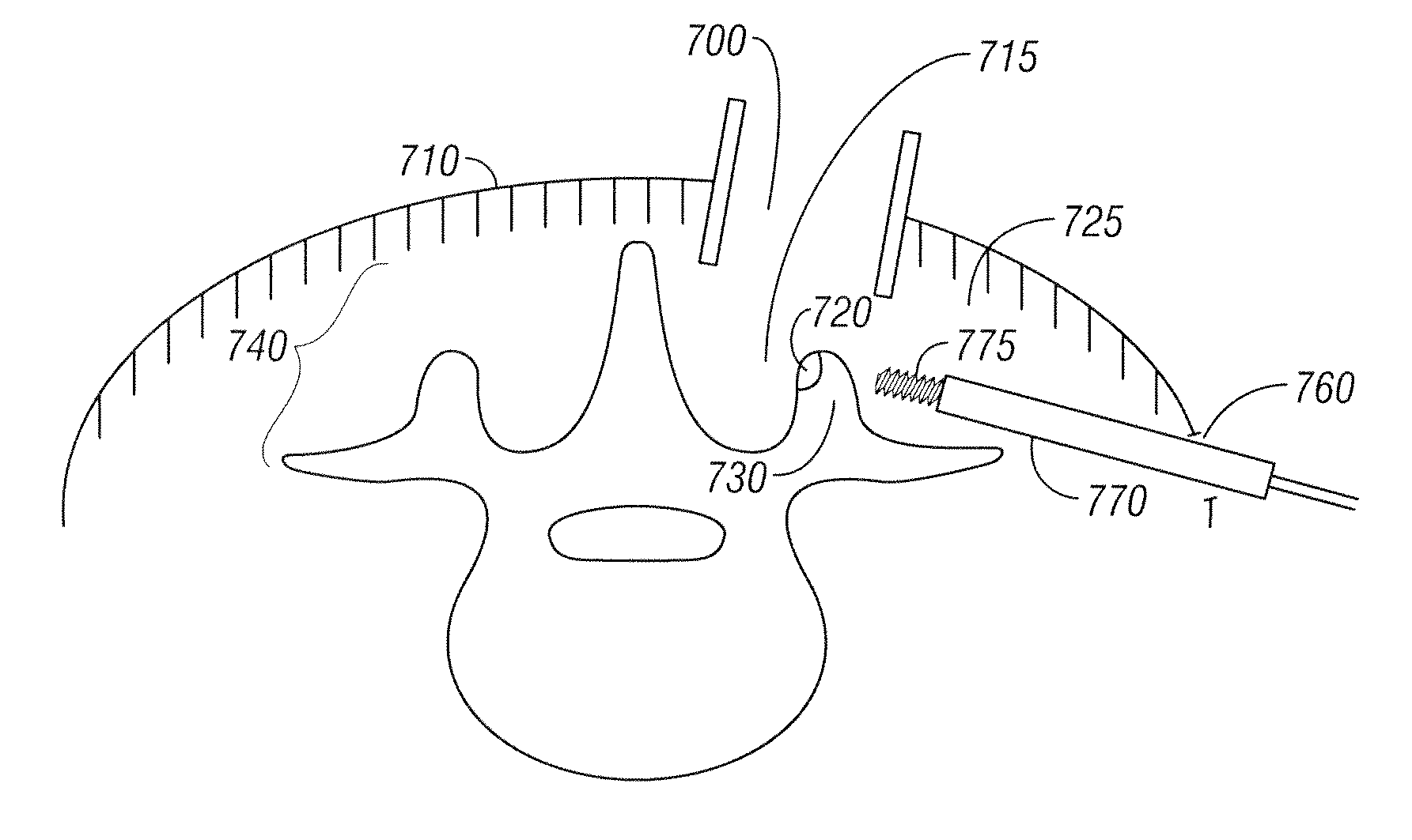 Method for accessing a spinal facet joint