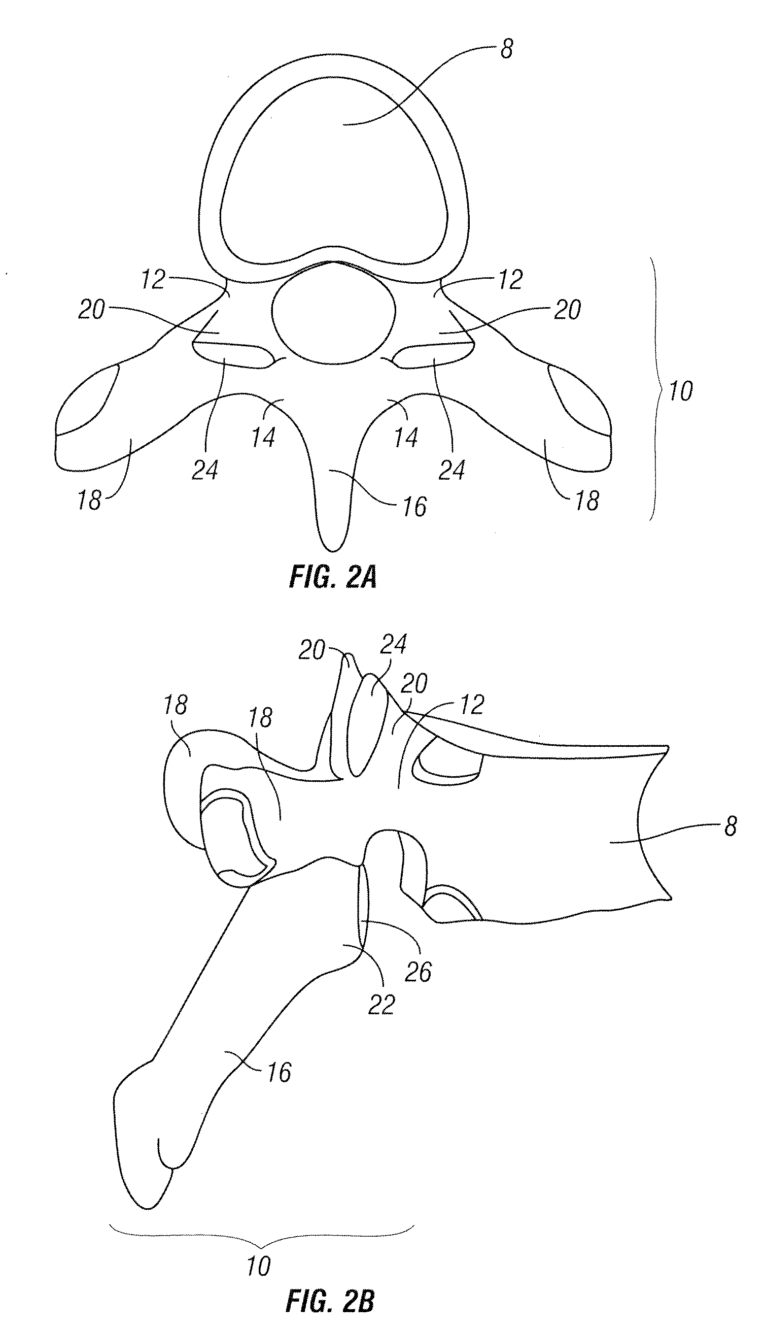 Method for accessing a spinal facet joint