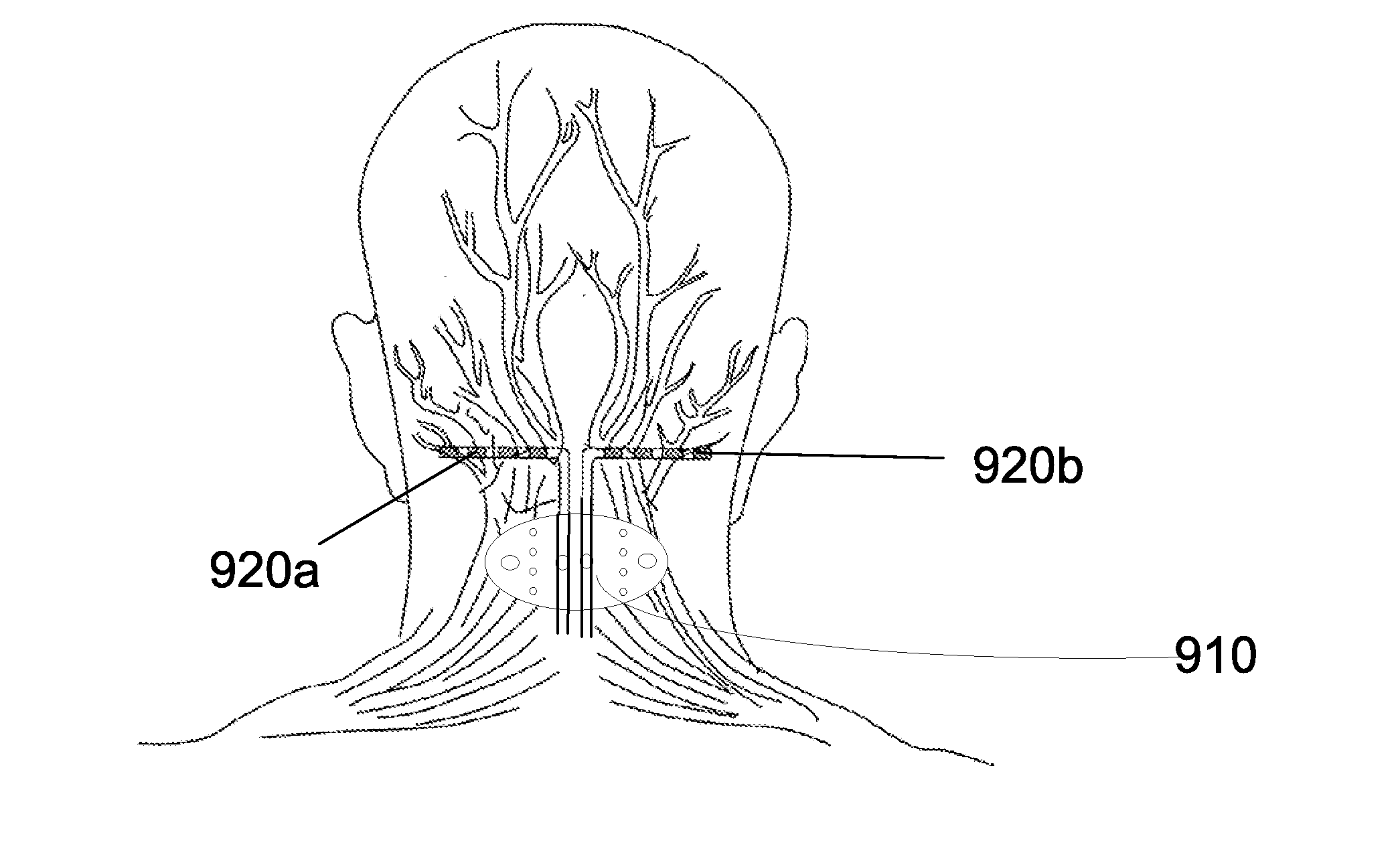 Anchor assembly for use in occipital nerve stimulation