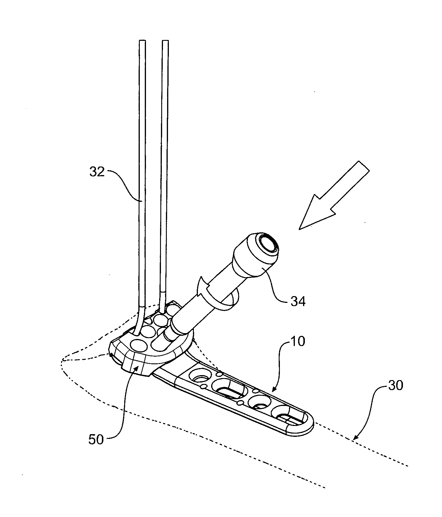 Tool jig for bone implant assembly