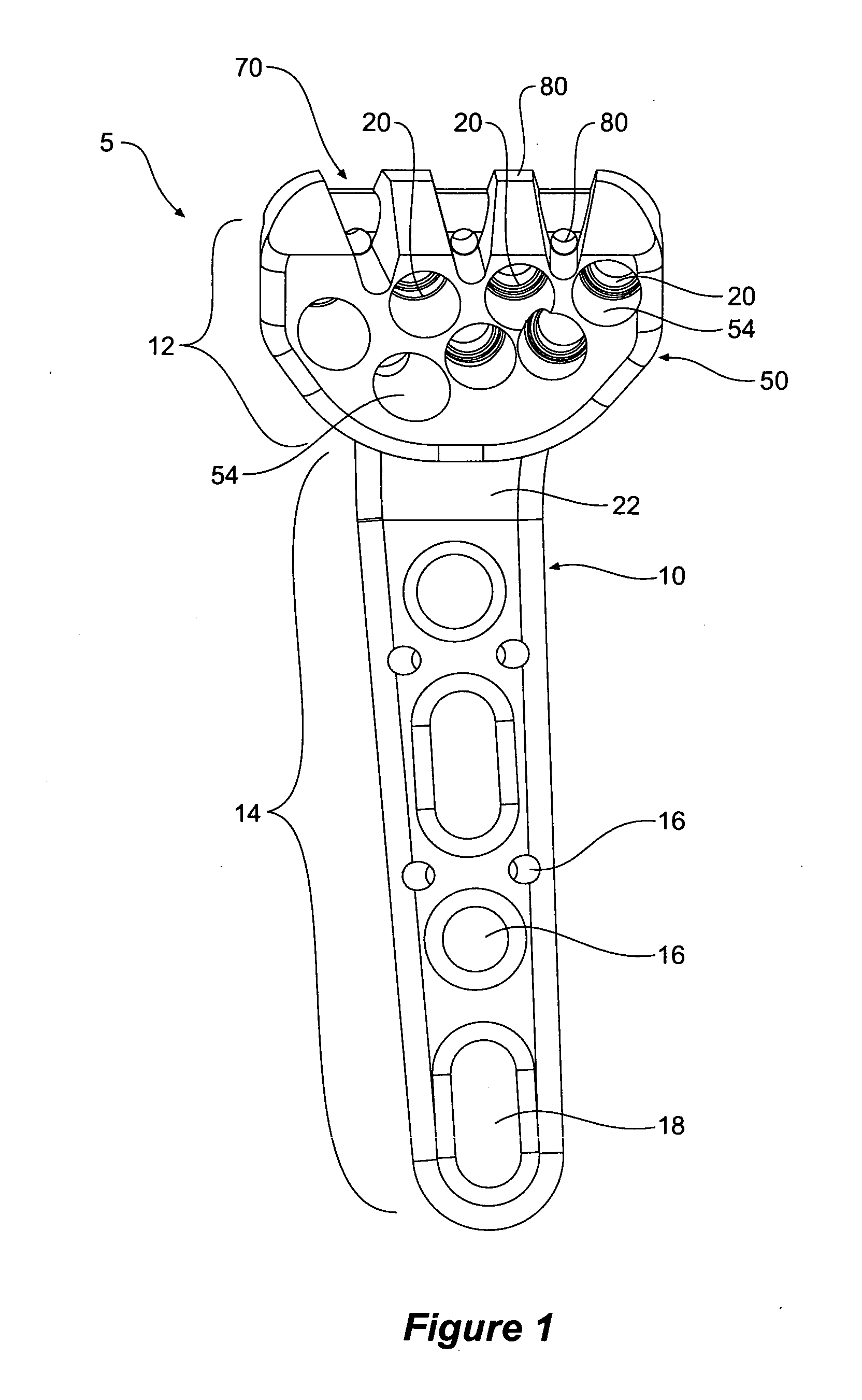 Tool jig for bone implant assembly