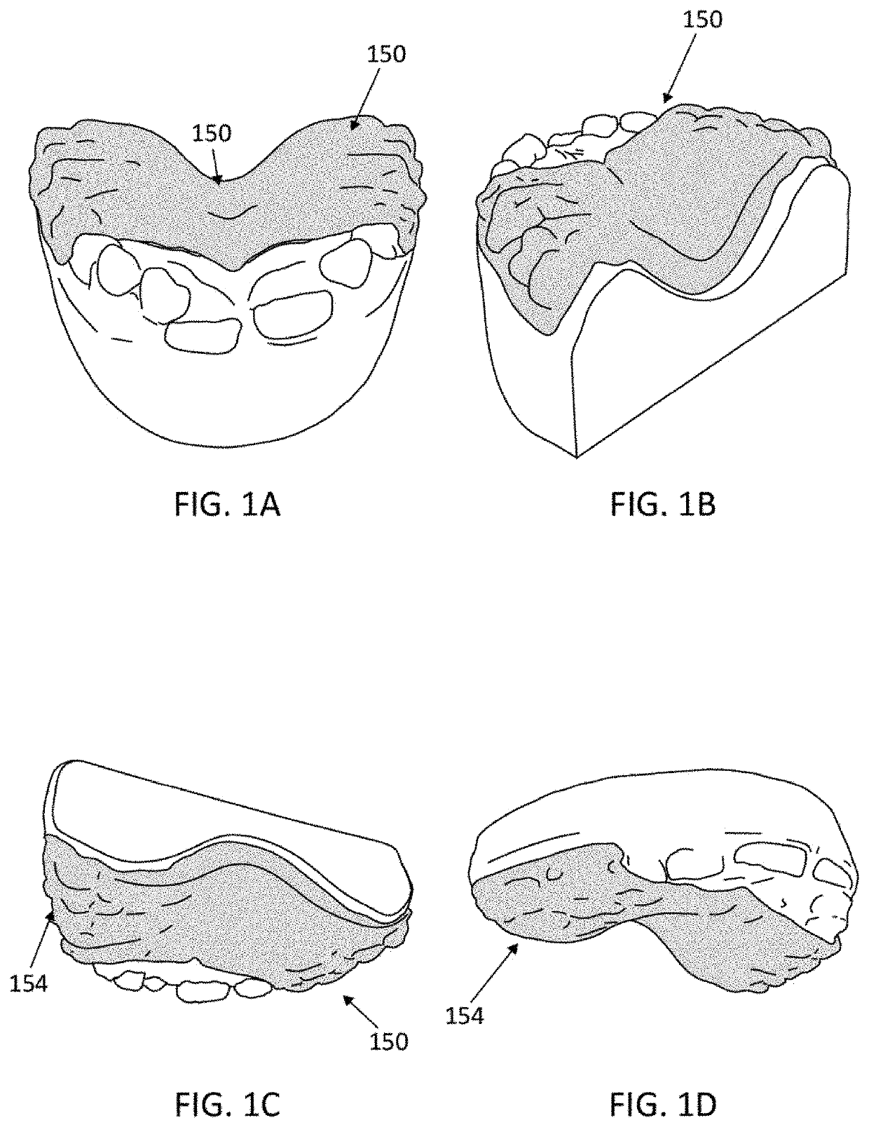 Palatal expanders and methods of expanding a palate