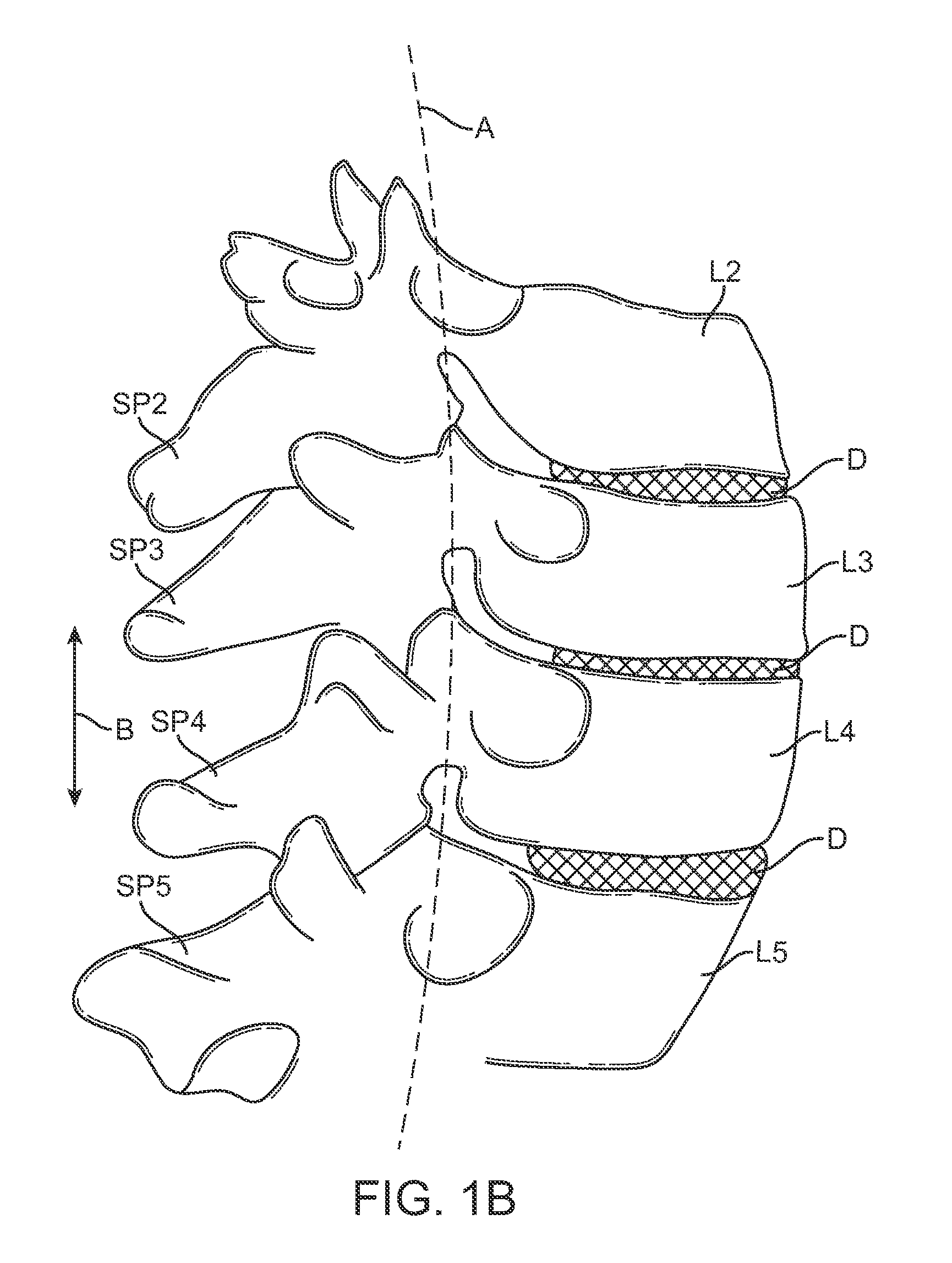 Methods and devices for restricting flexion and extension of a spinal segment