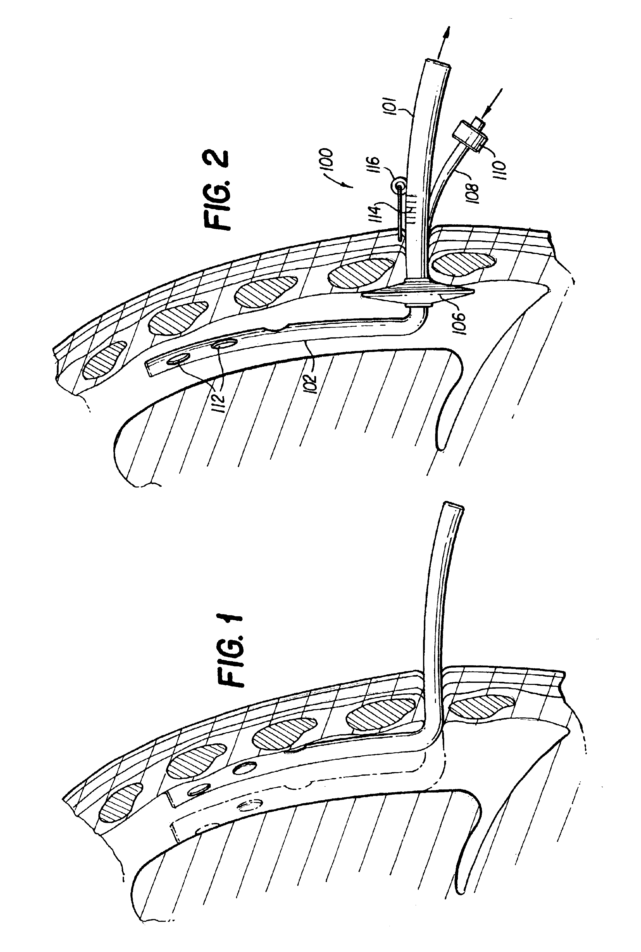 Method and apparatus for pleural drainage