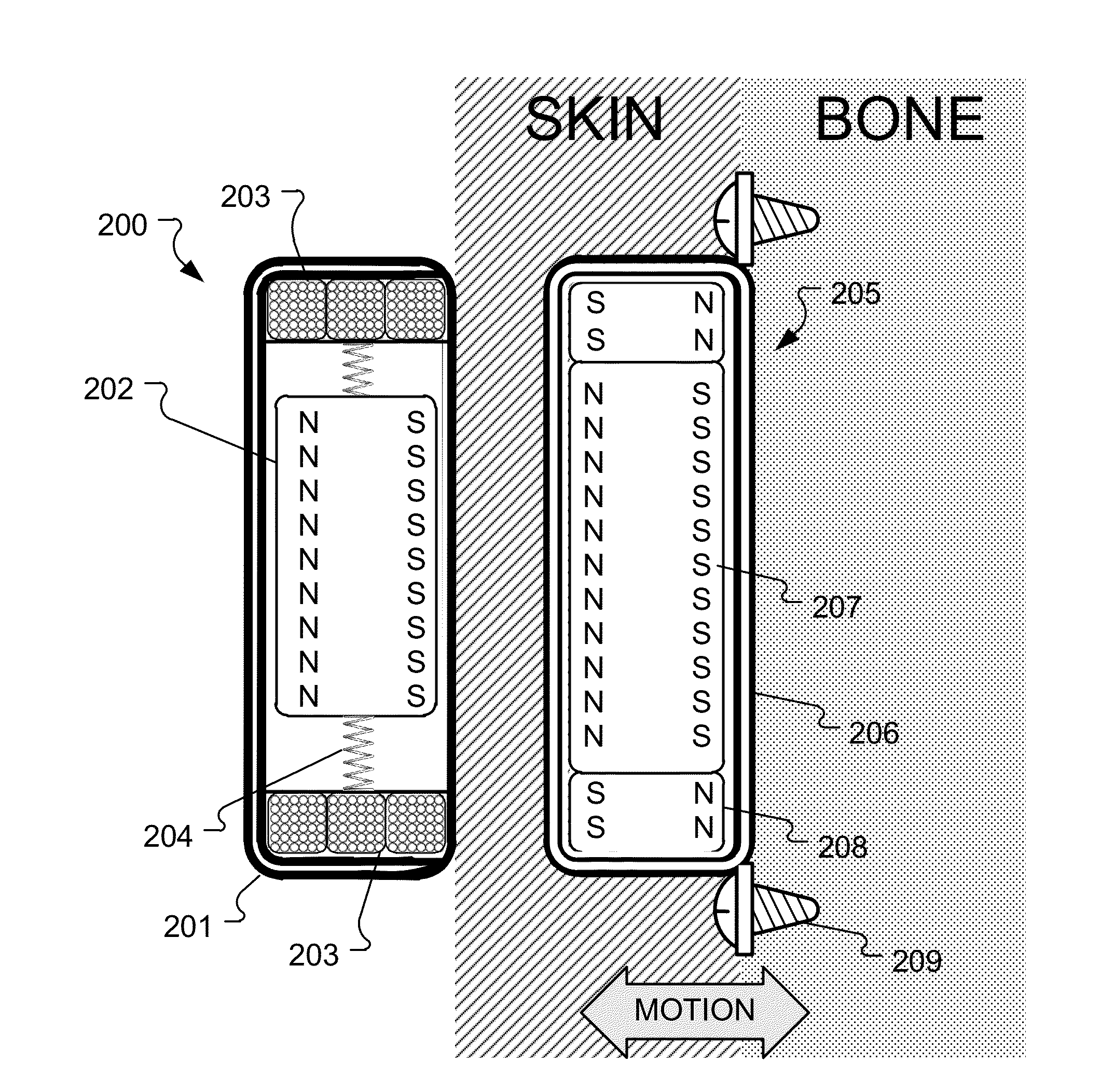 Electromagnetic Bone Conduction Hearing Device