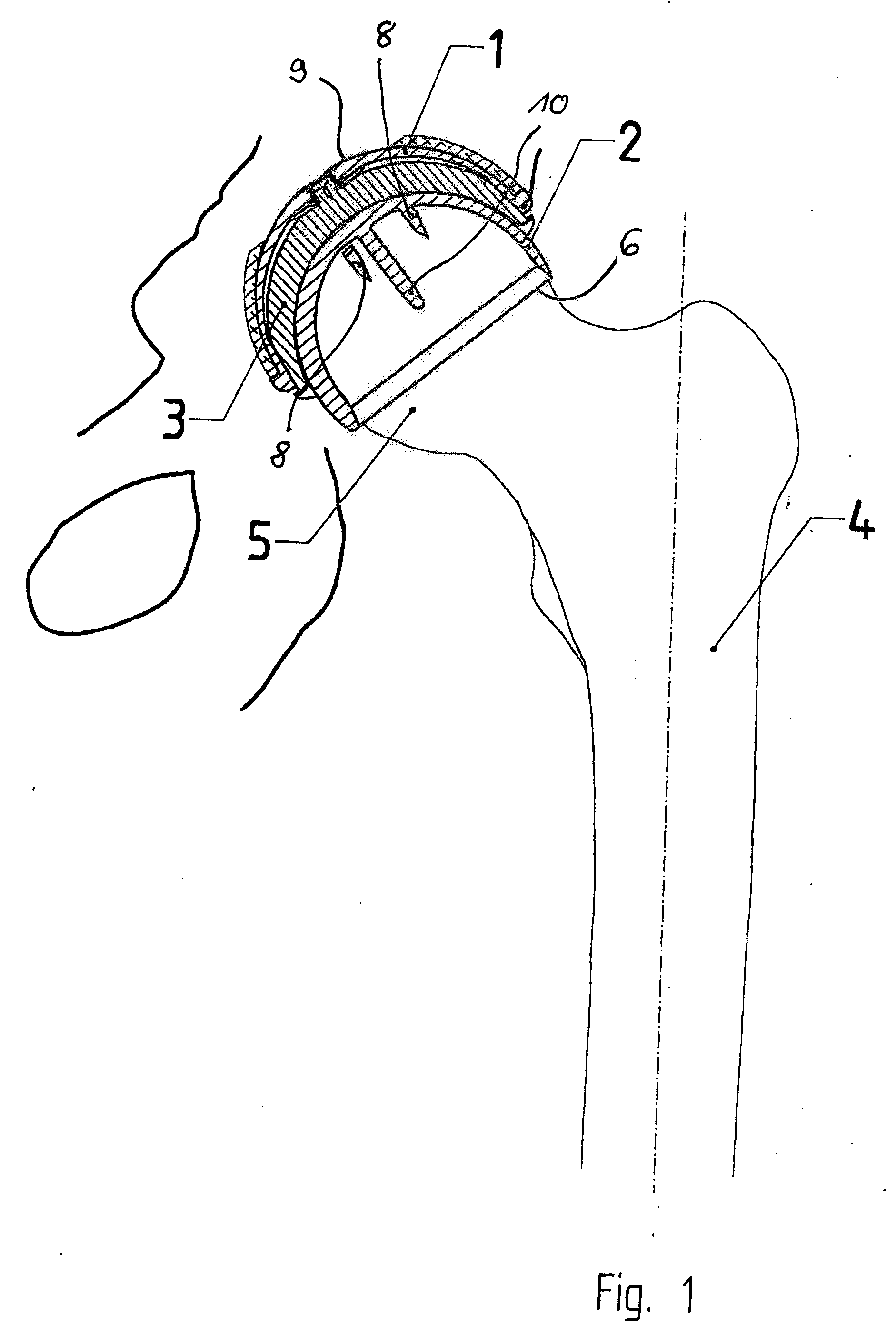 Set For Creating An Offset-Resurfacing Hip-Joint Implant