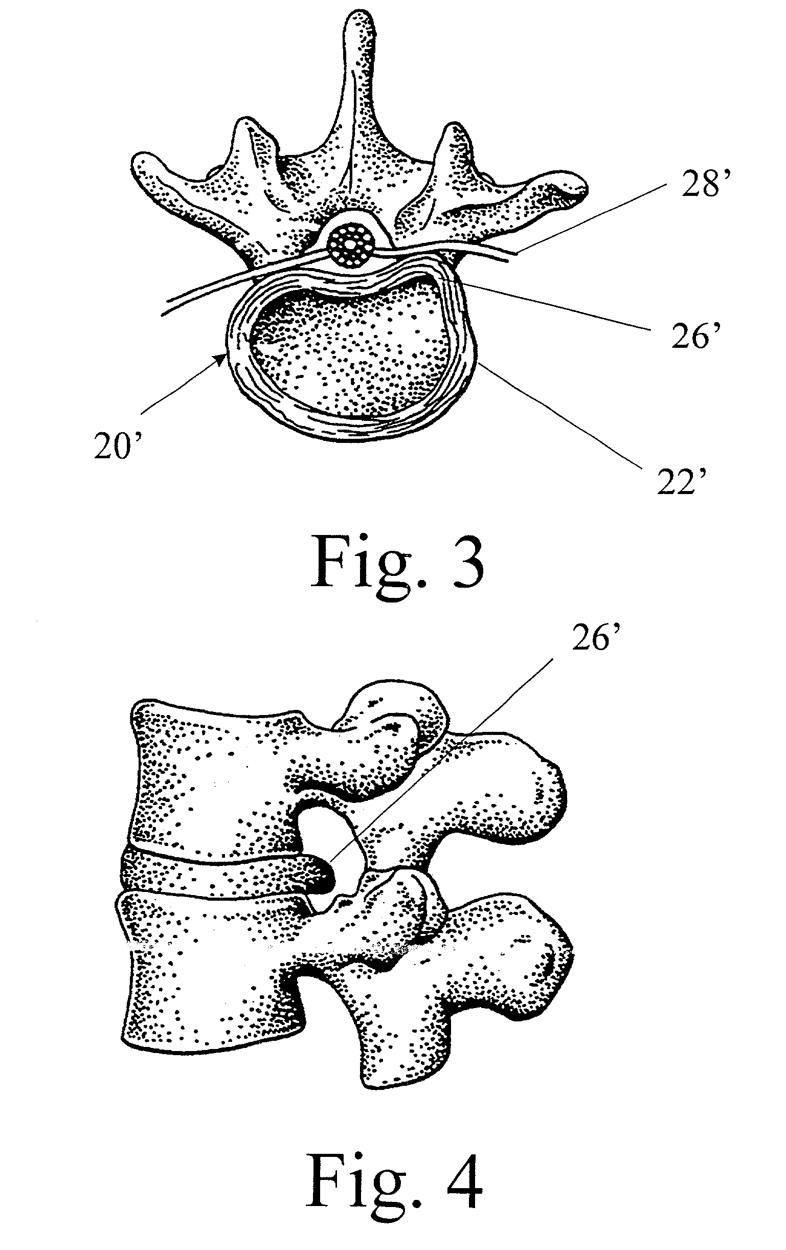 Multiportal device with linked segmented cannulae and method for percutaneous surgery