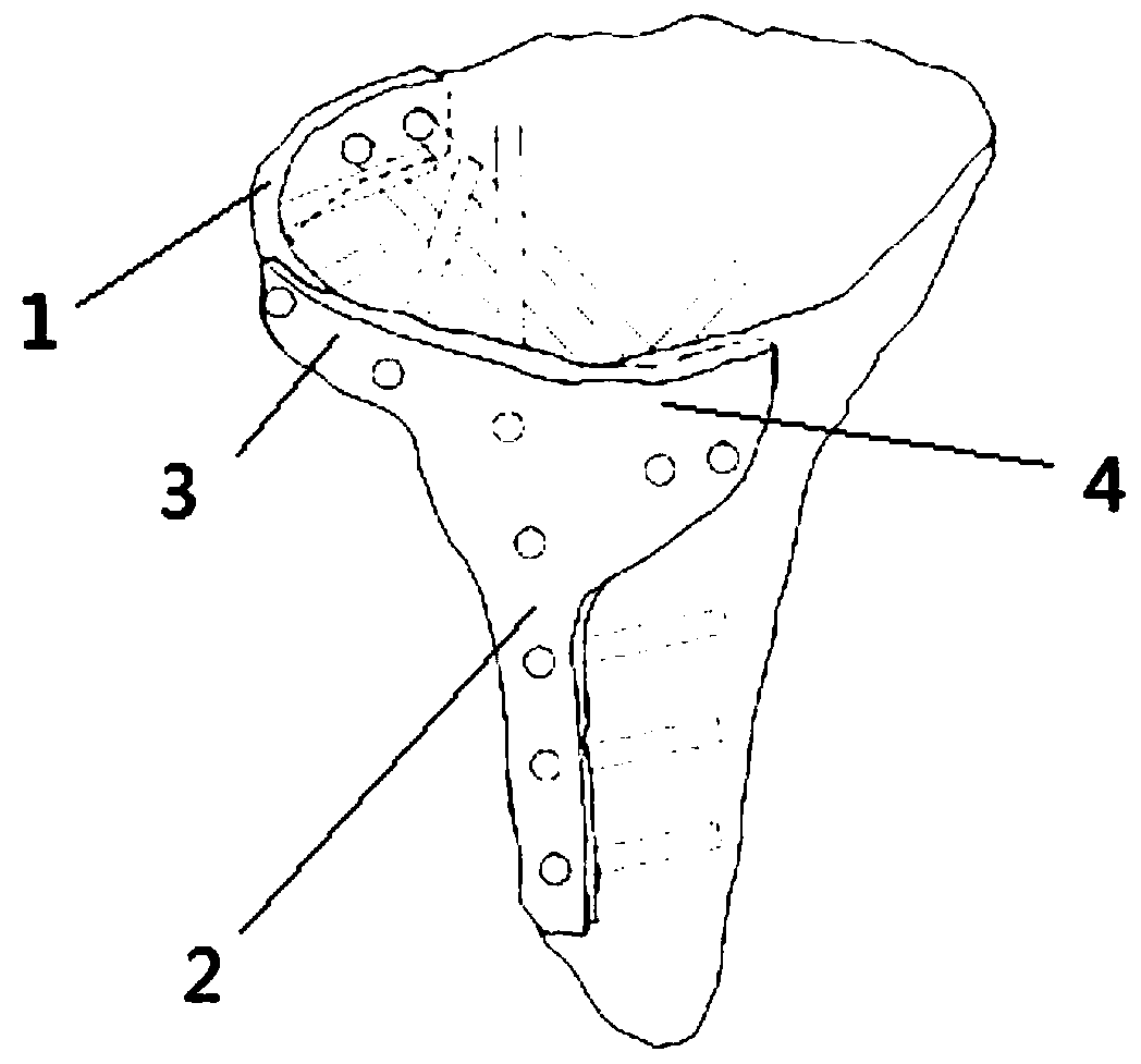 Combined tibial plateau back outer side dissection steel plate