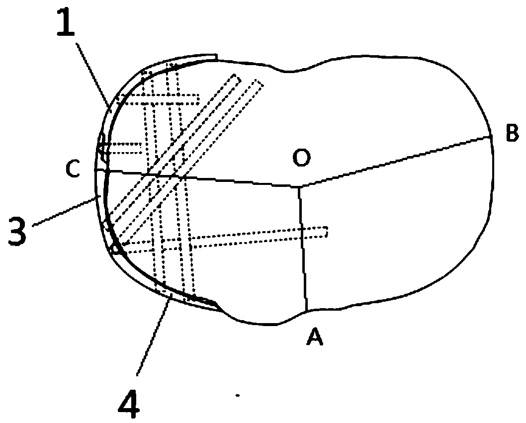 Combined tibial plateau back outer side dissection steel plate