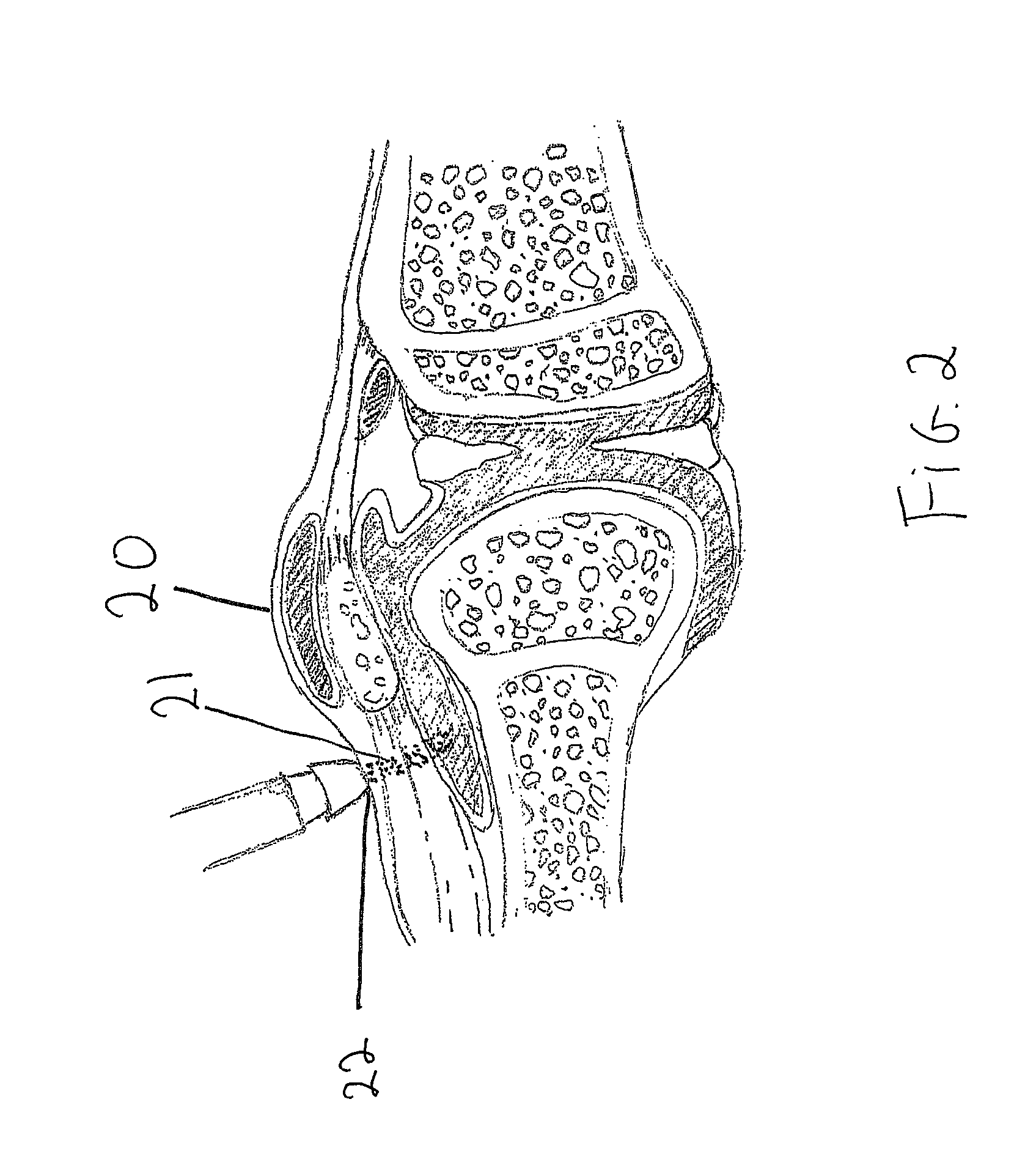 Device and method for treating musculo-skeletal injury and pain by application of laser light therapy