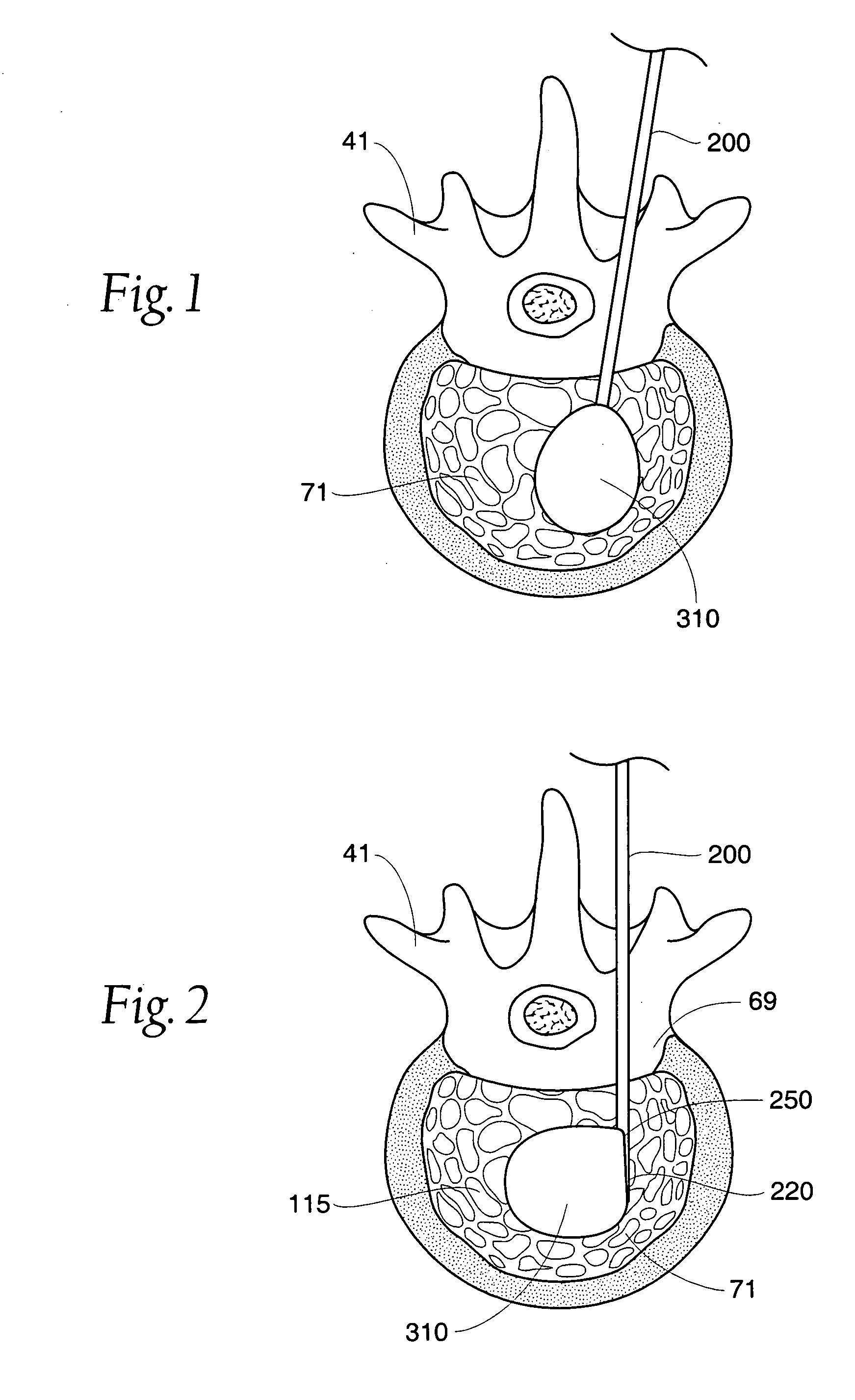 Insertion devices and method of use