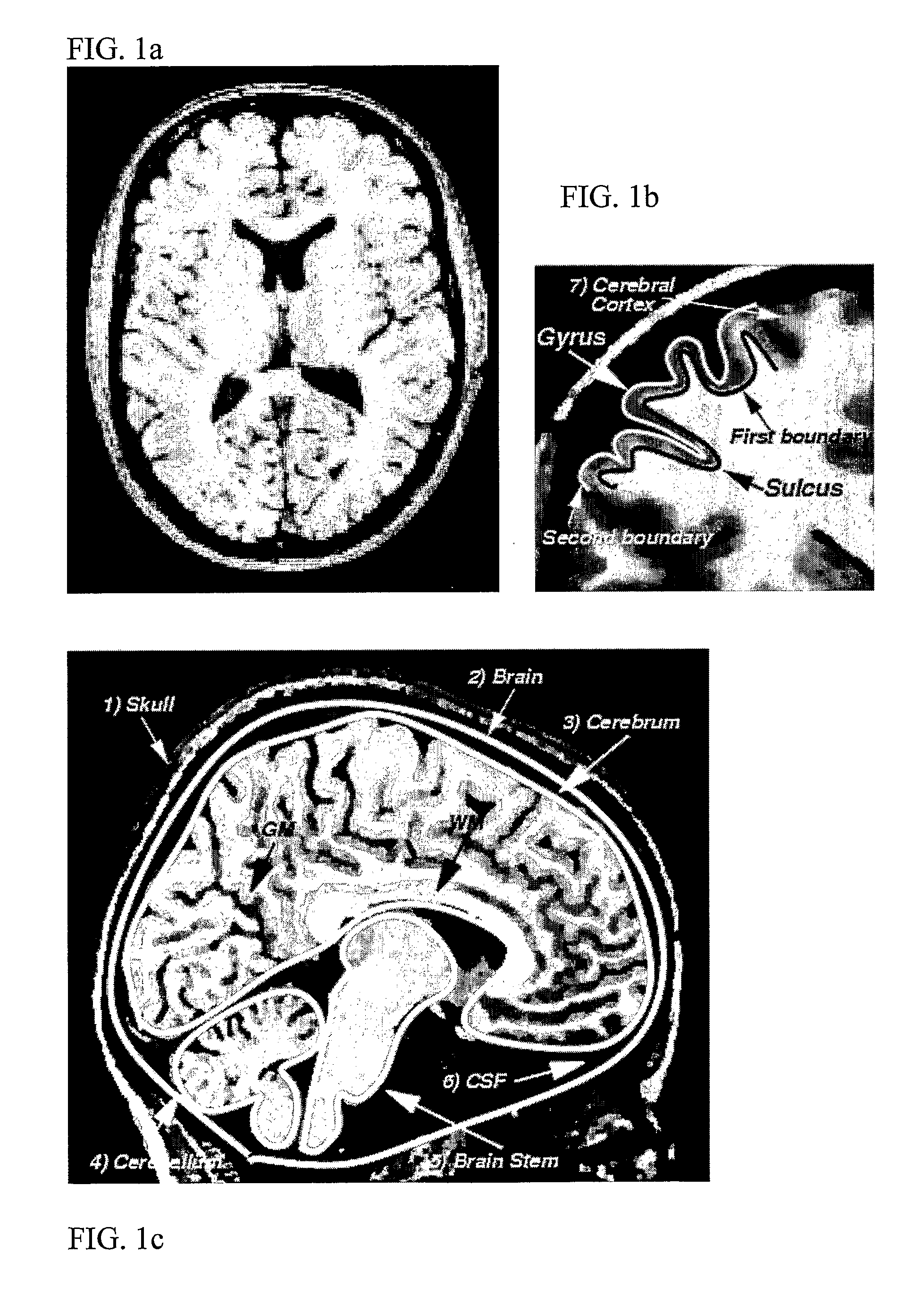 Computerised cortex boundary extraction from MR images