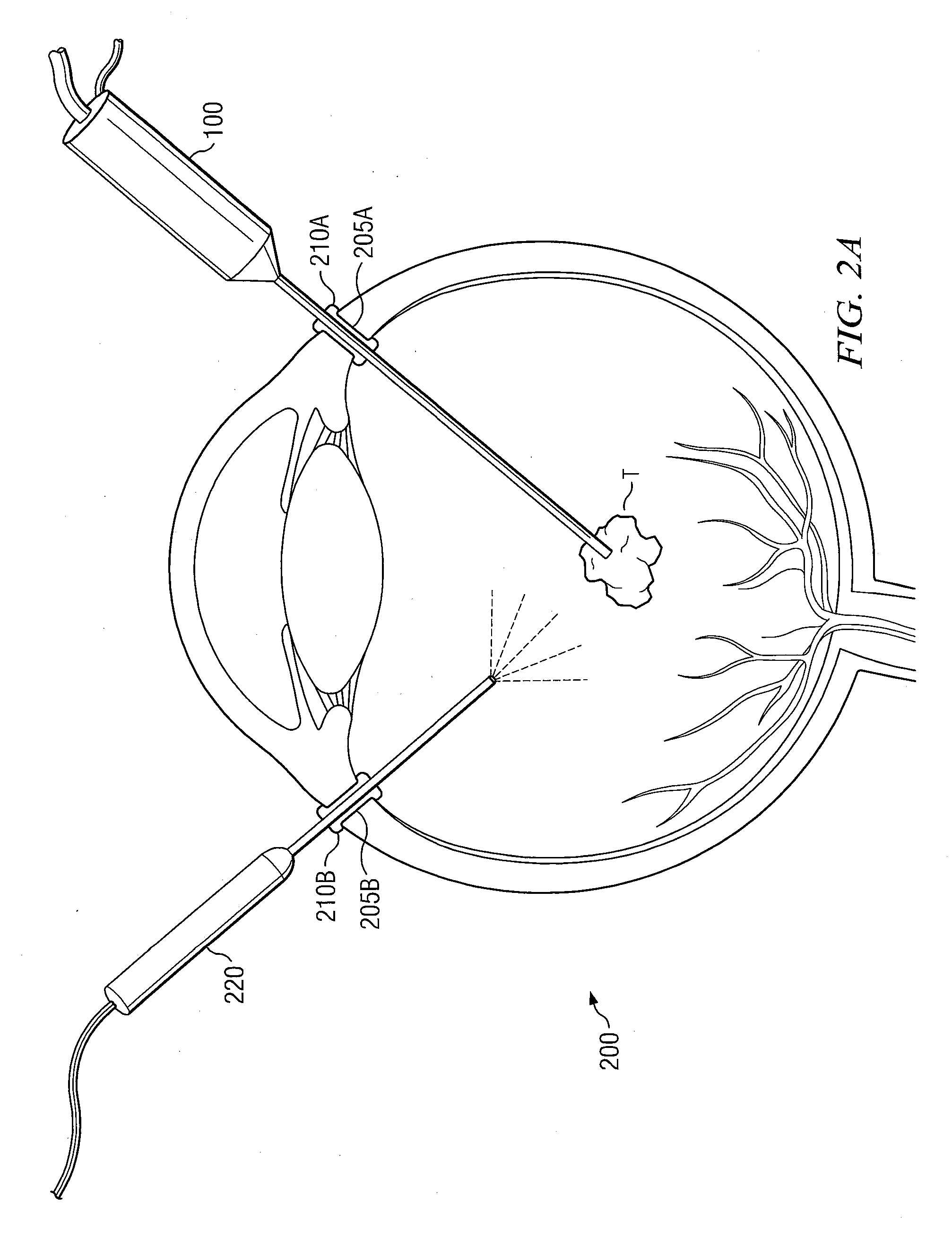 Method for removal of retained lens fragments using small diameter fragmatome