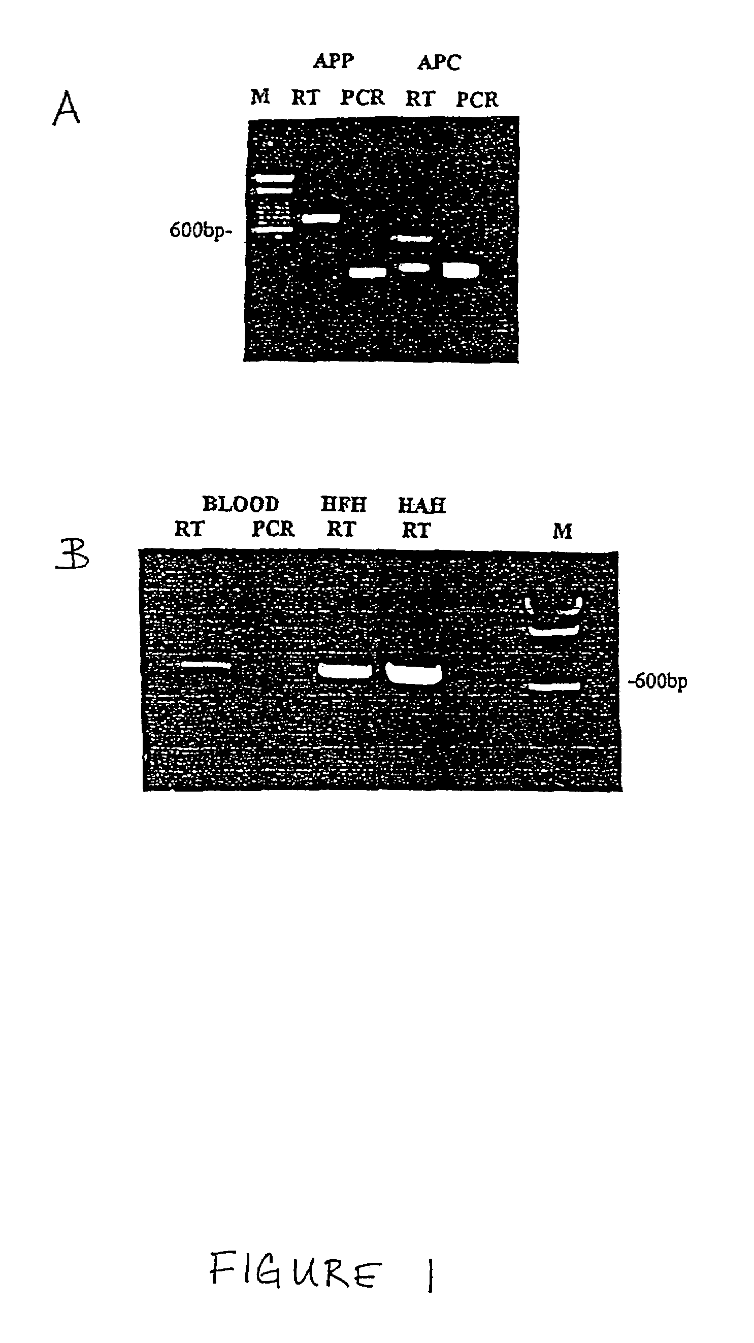 Method for the detection of Chagas disease related gene transcripts in blood