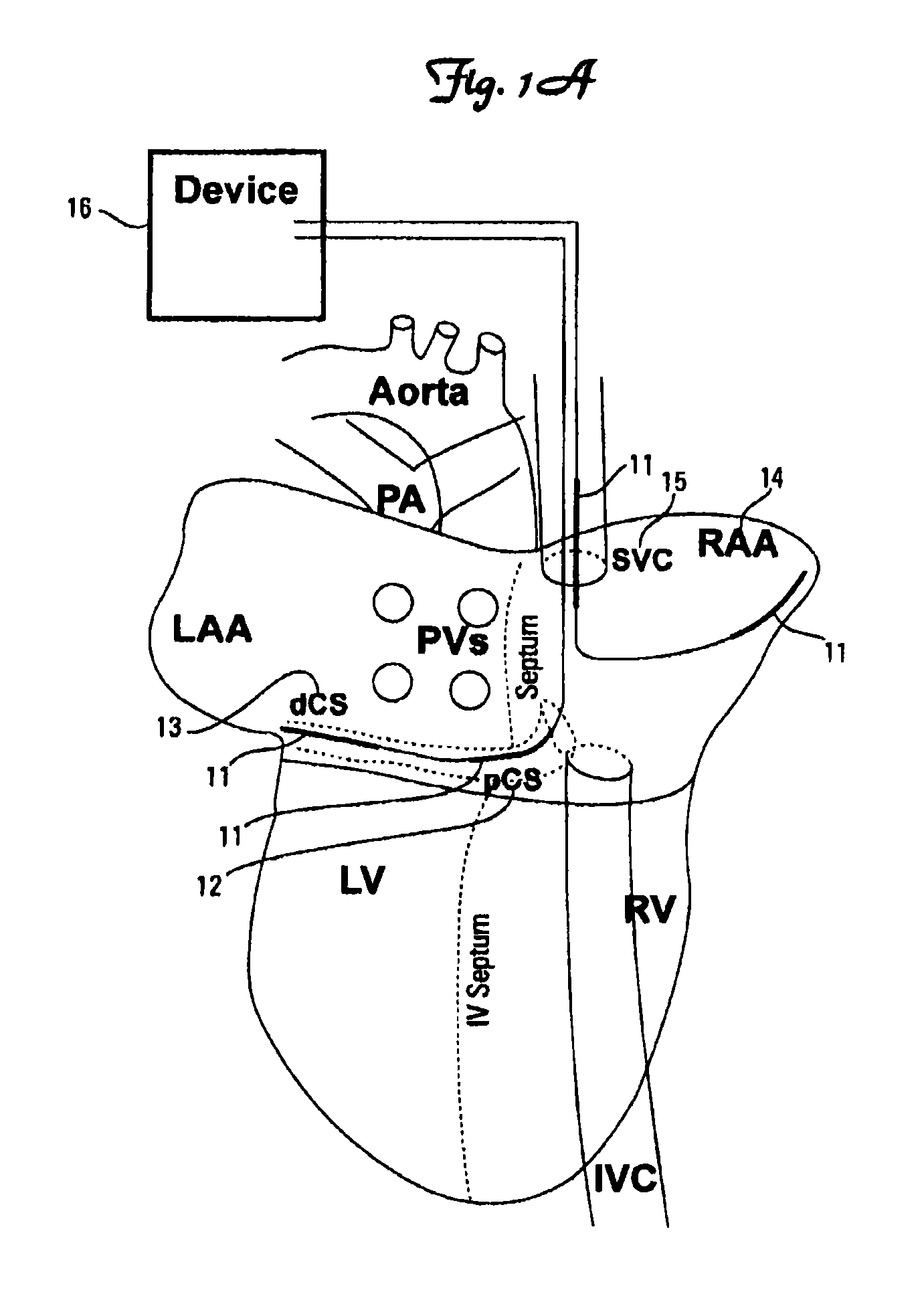 Method and device for three-stage atrial cardioversion therapy