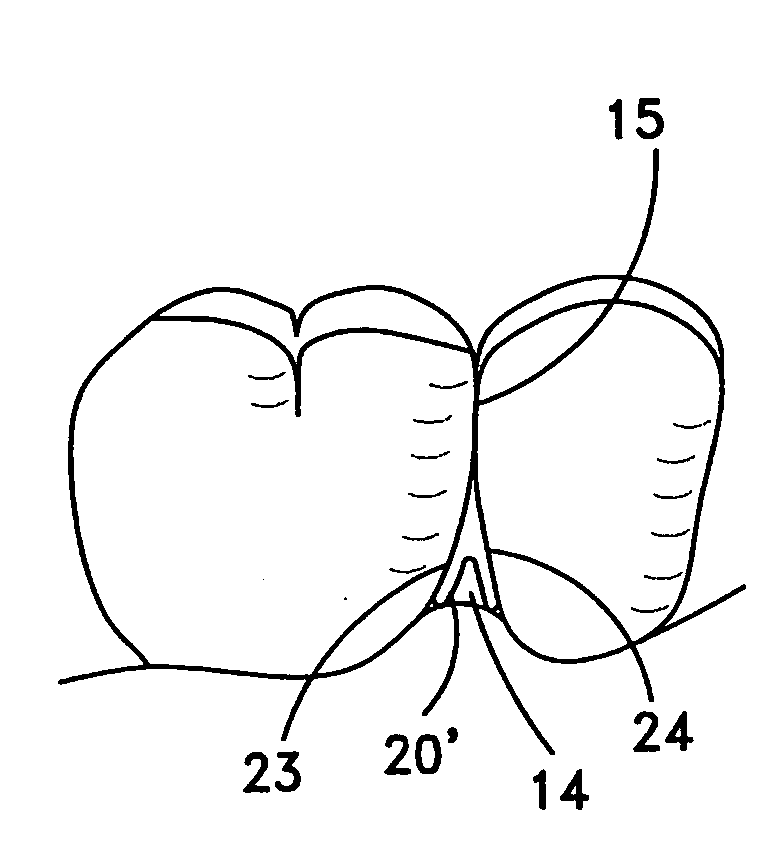 Reshapable device for fixation at a dental site