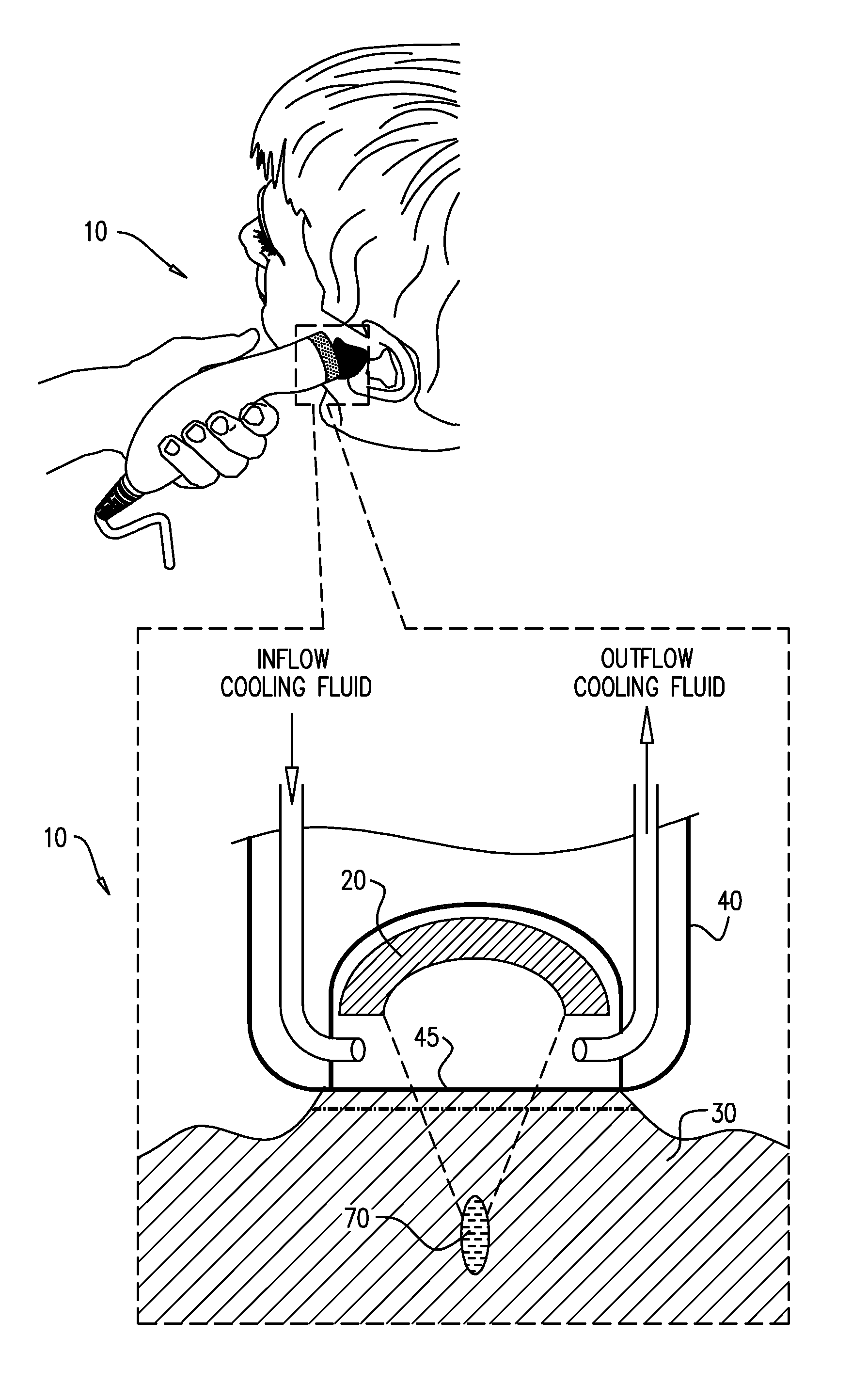 Method and device for treatment of keloids and hypertrophic scars using focused ultrasound
