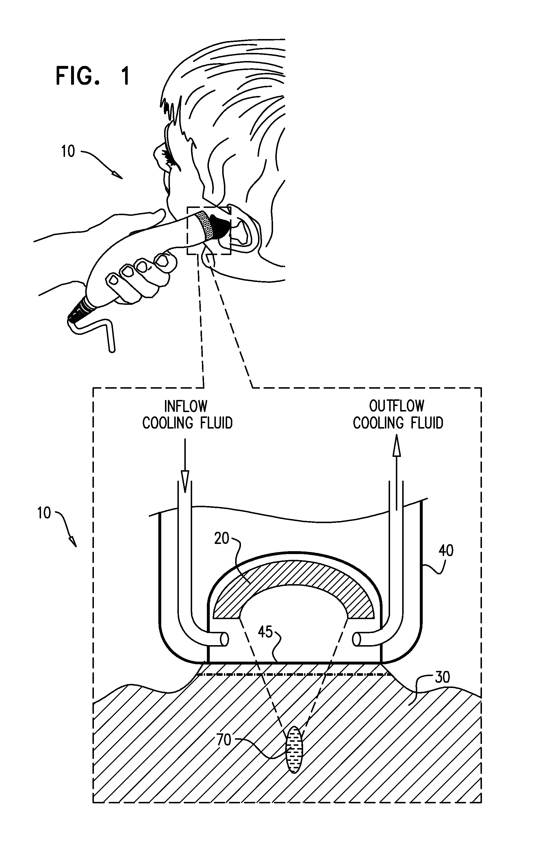 Method and device for treatment of keloids and hypertrophic scars using focused ultrasound