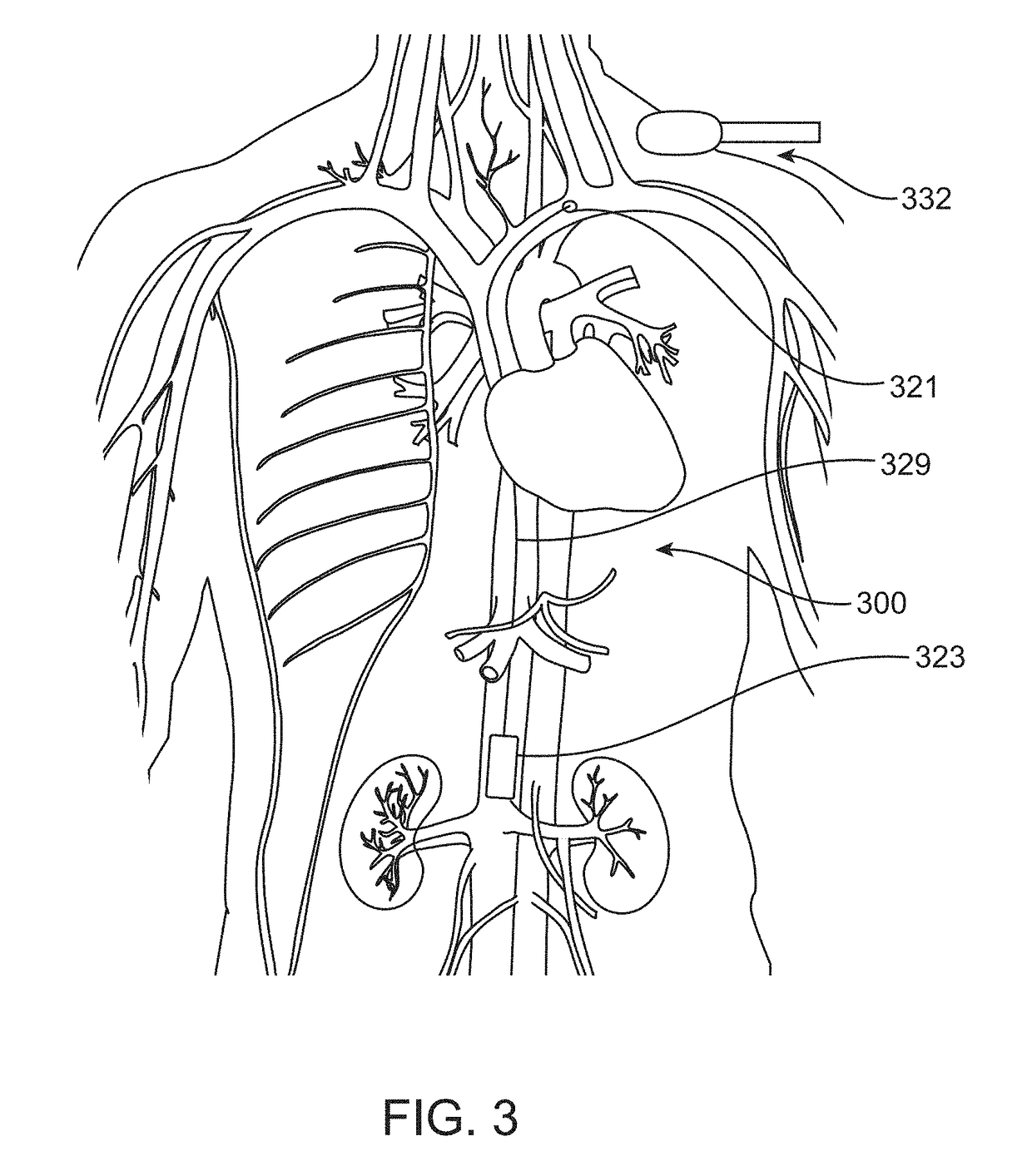 Implantable Devices and Related Methods for Heart Failure Monitoring